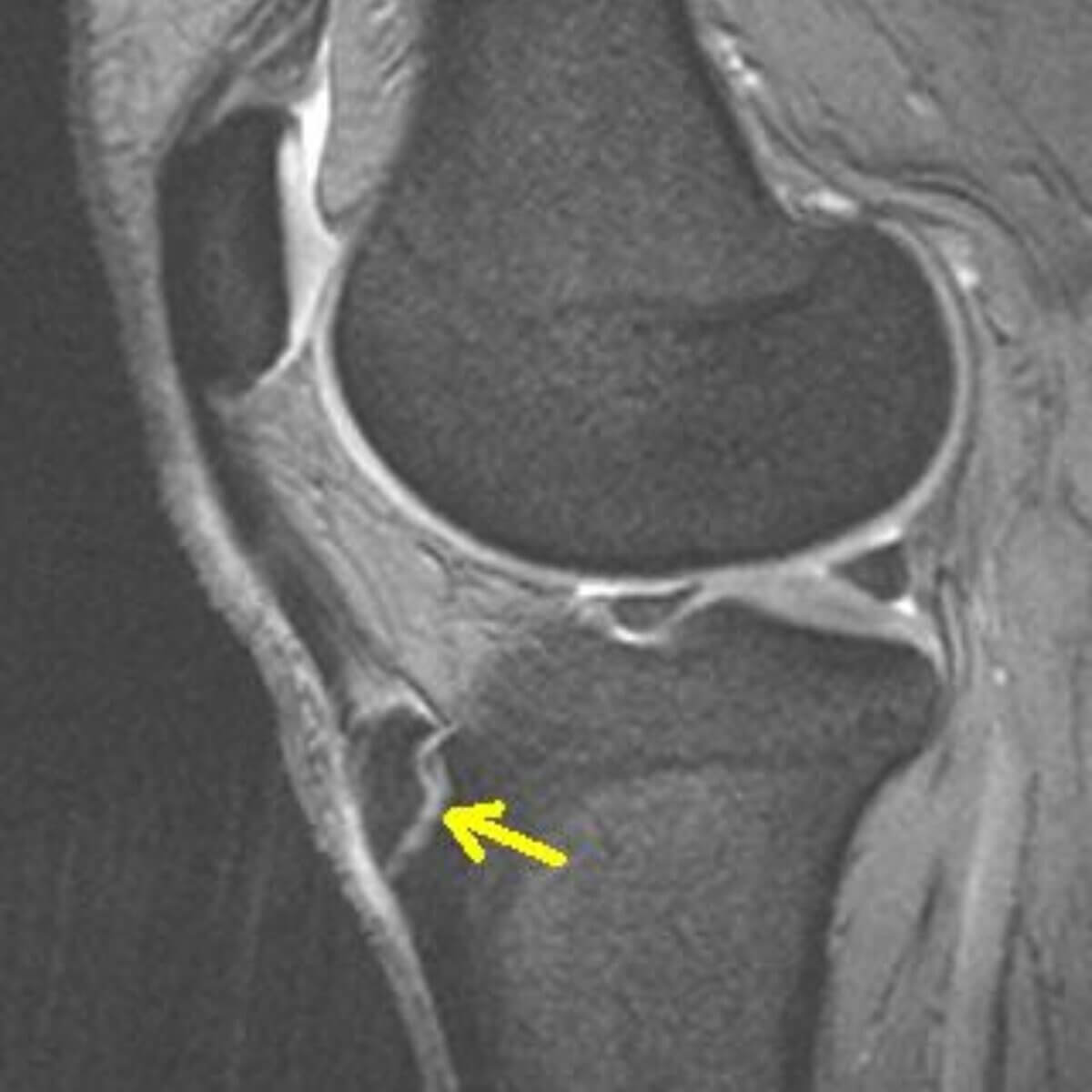 Morbus Osgood-Schlatter