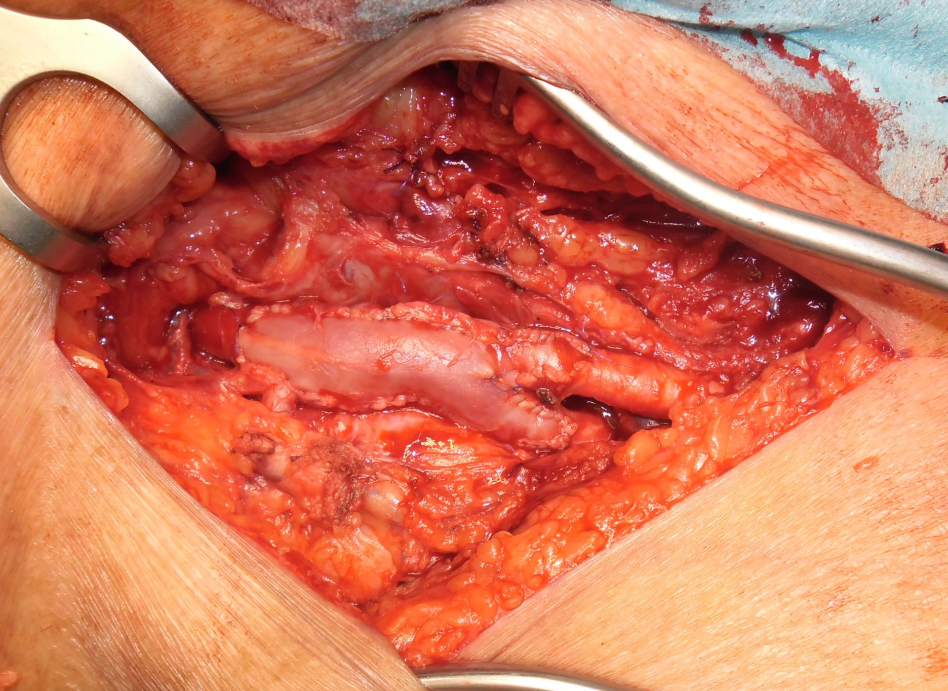 Tromboendarterectomía bifurcación femoralis con parche venoso