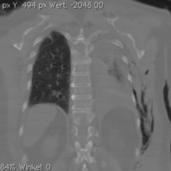 Hautemphysem DocCheck Flexikon