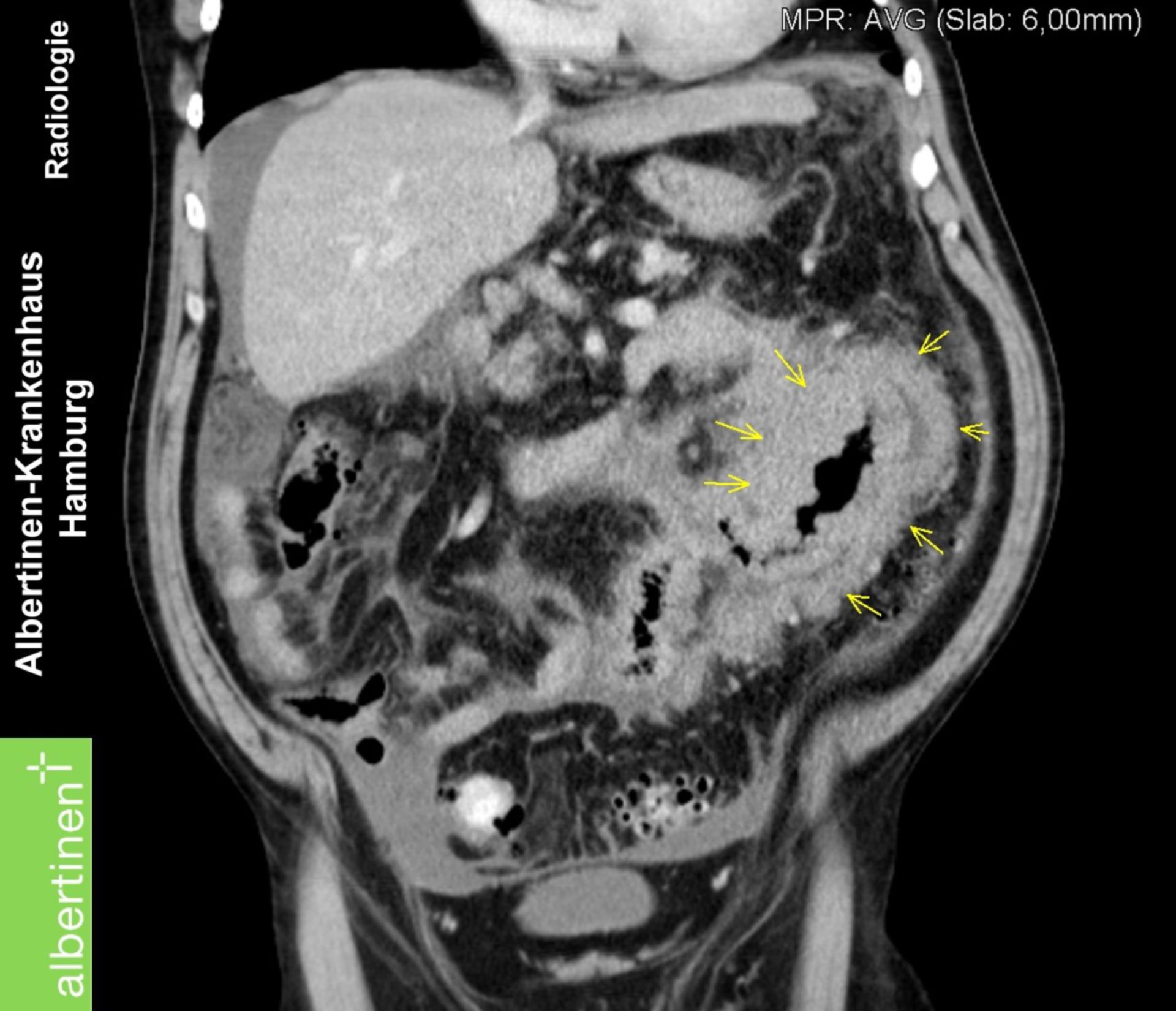 Burkitt-Lymphom-Dünndarm coronar CT