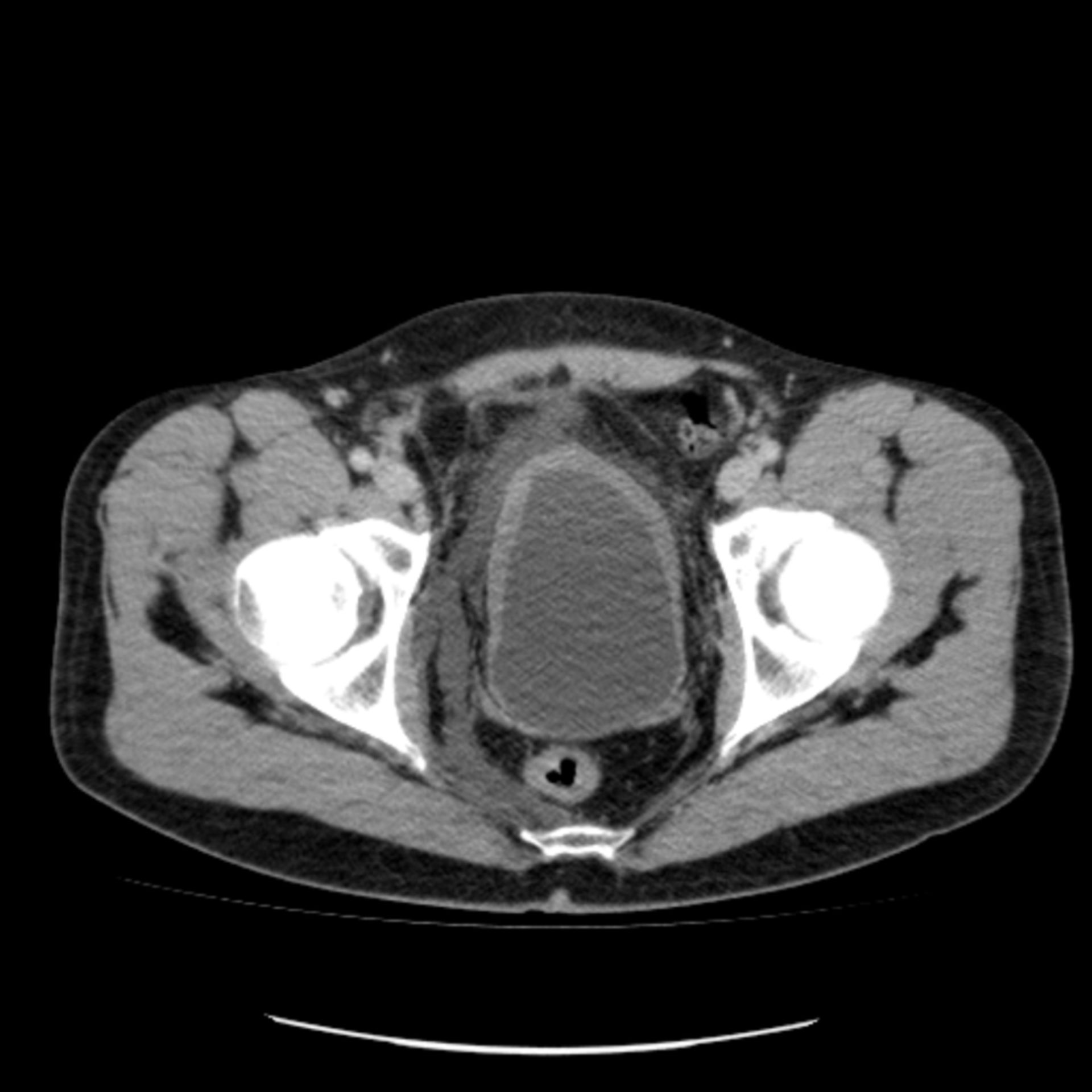 ct6: CT des Beckens in transversaler Ebene