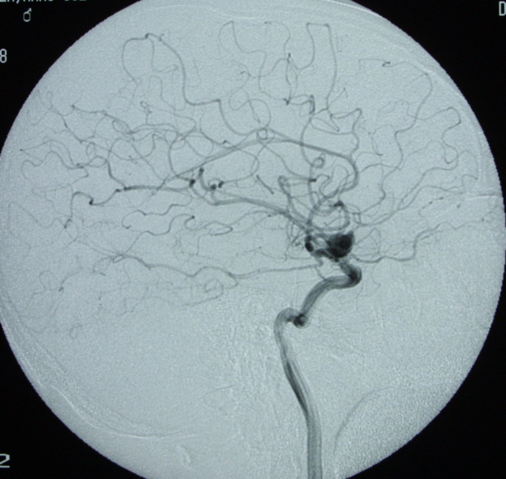 Aneurysm - lateral angiography