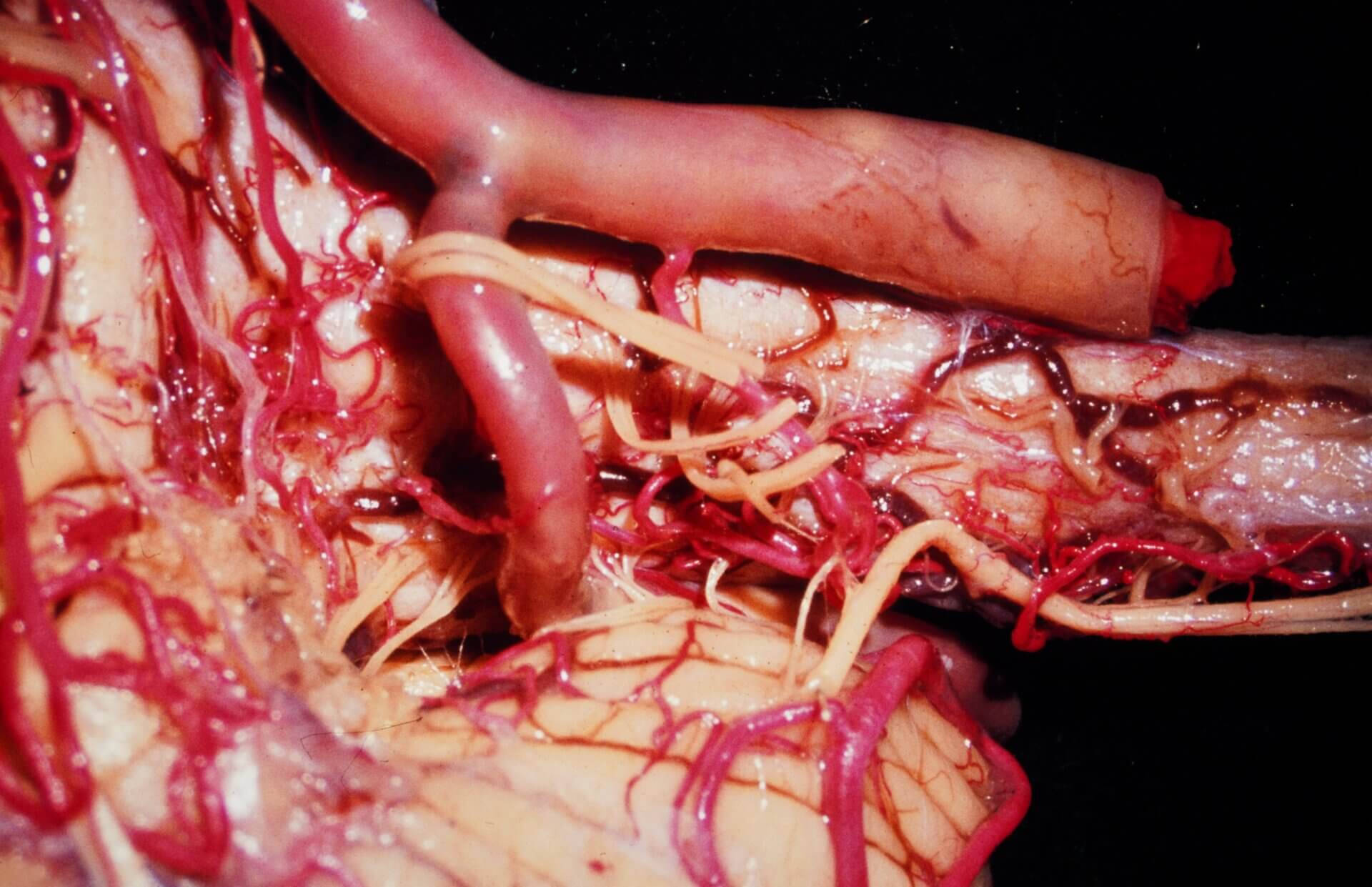 Hirnstamm mit Arteria basilaris