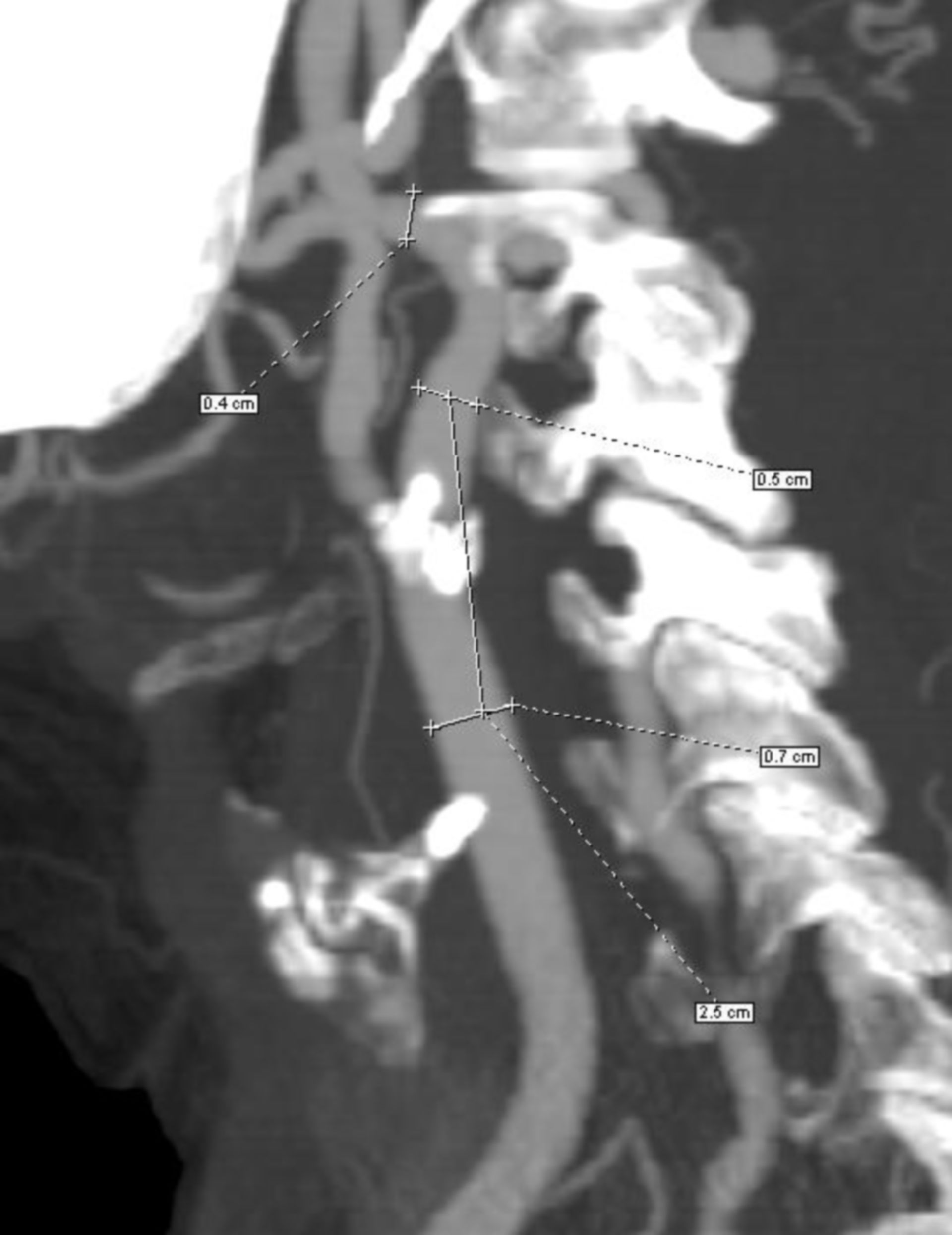 Carotis-Angioplastie mit Stentversorgung (Operationsplanung)