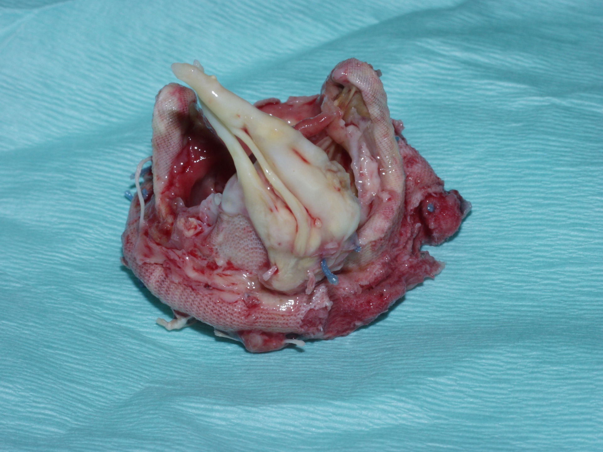 Explantierte Mitralklappen-Prothese