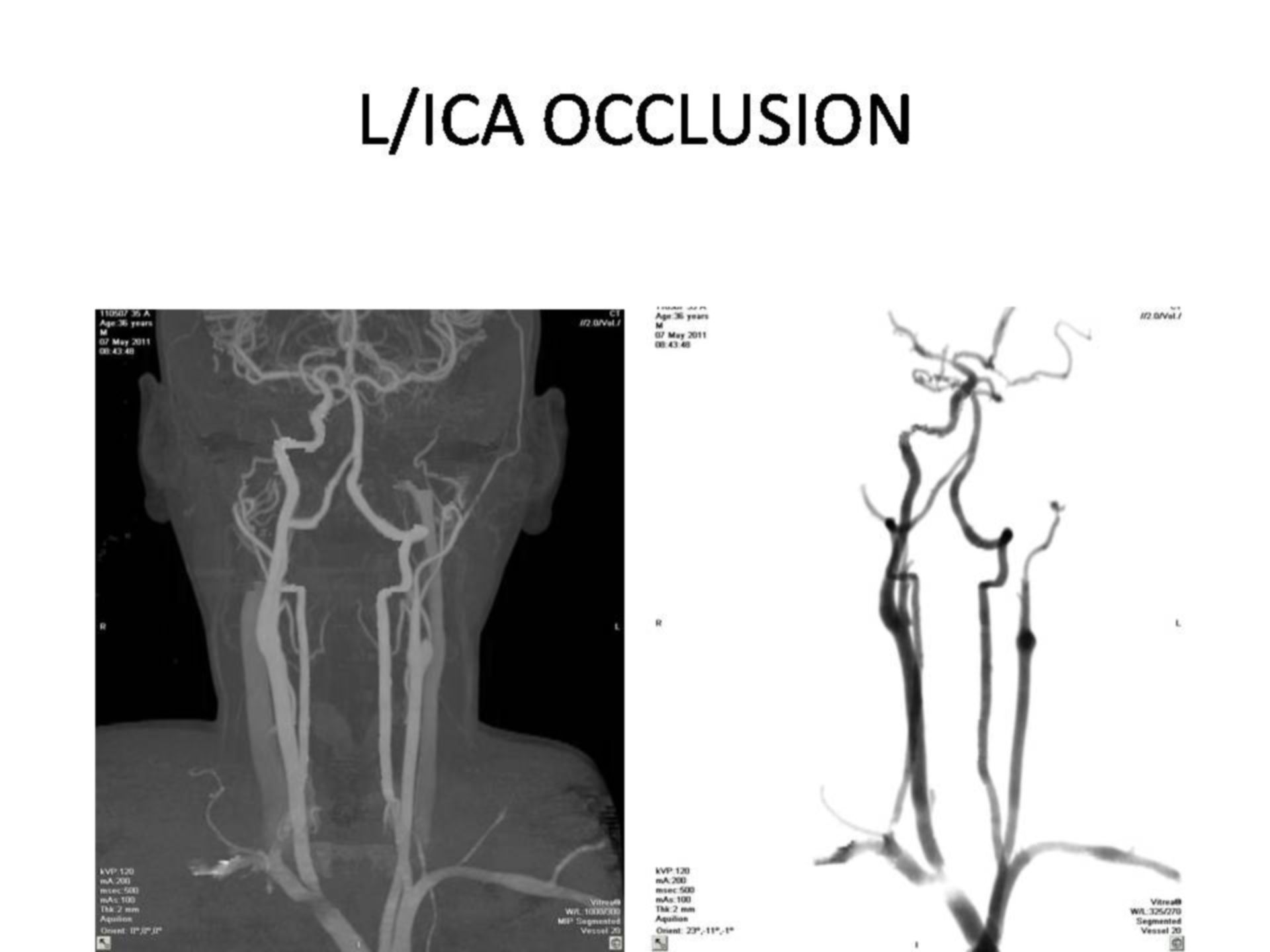 Okklusion der Arteria carotis interna (3)