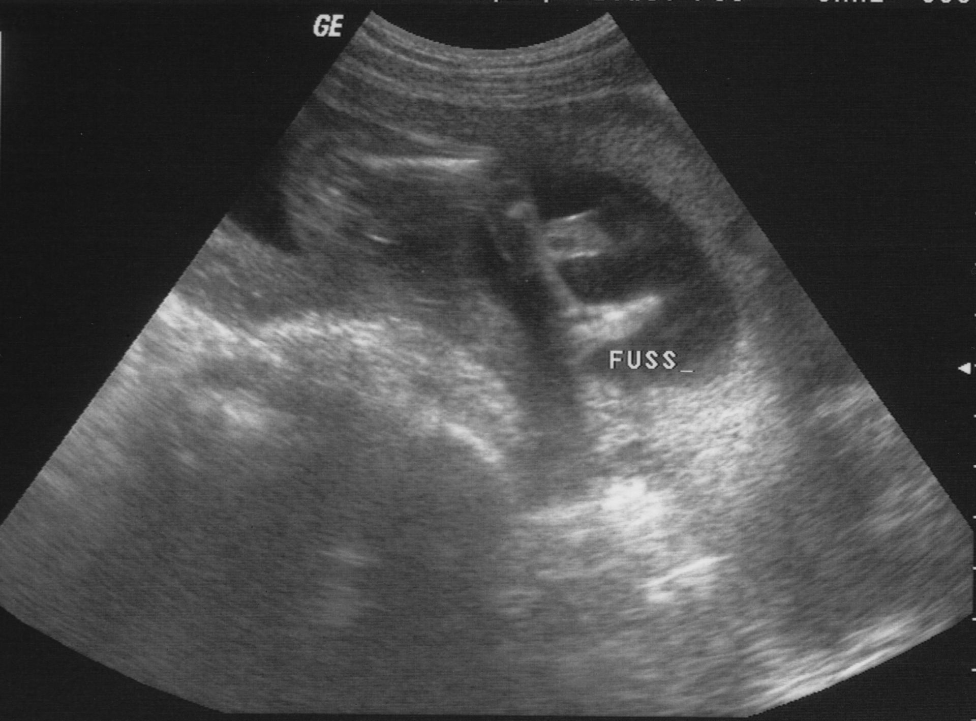 Ultrasound image - 18 weeks pregnant