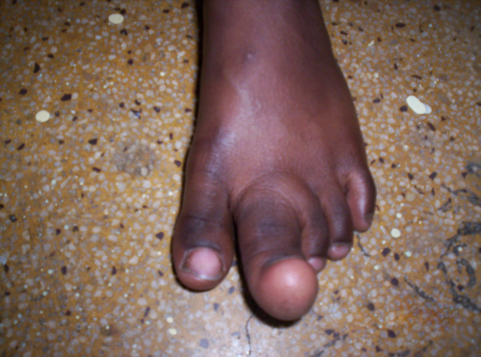 local gigantism of 2nd toe
