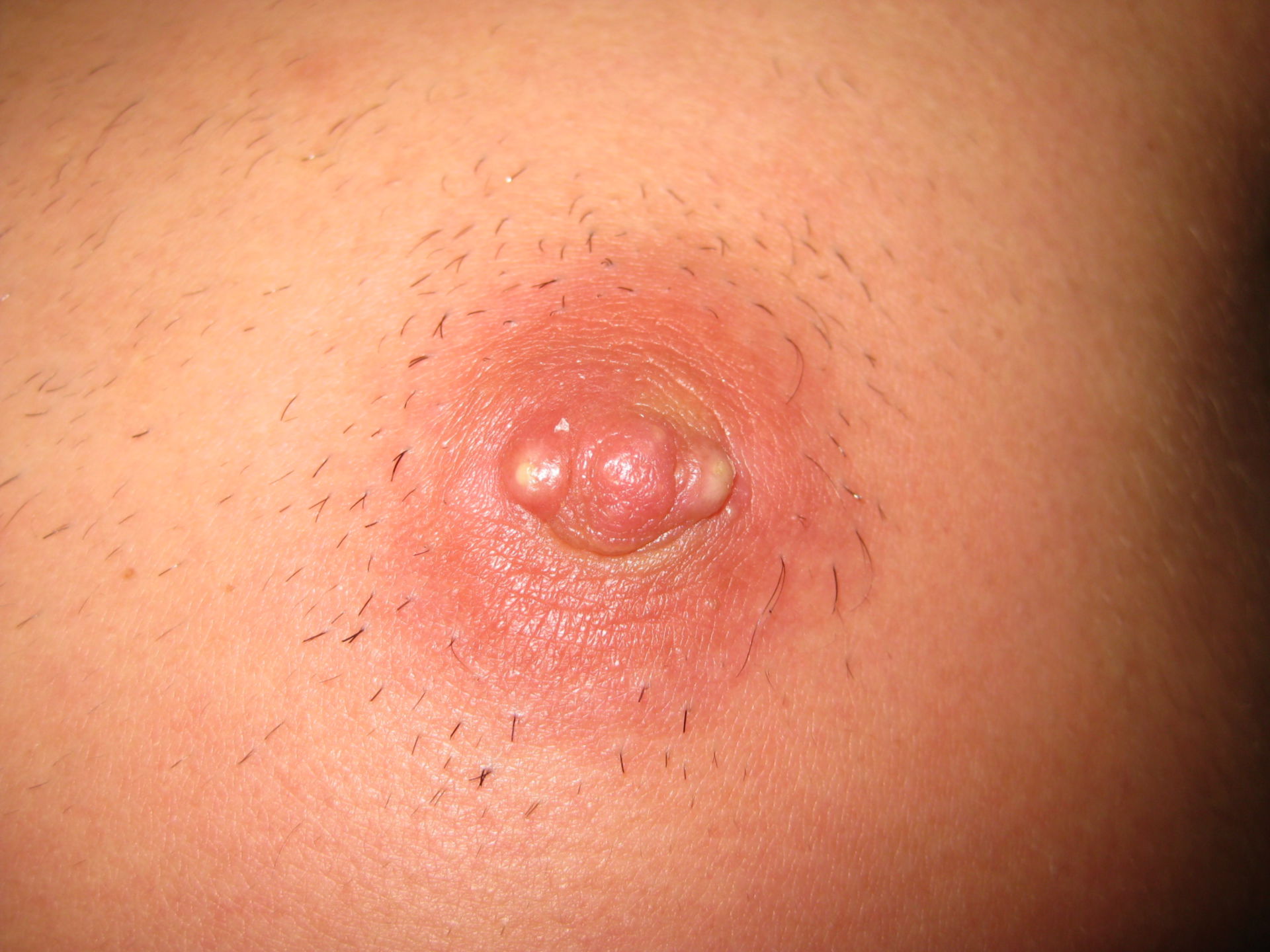 Mamillary abscess after nipple piercing