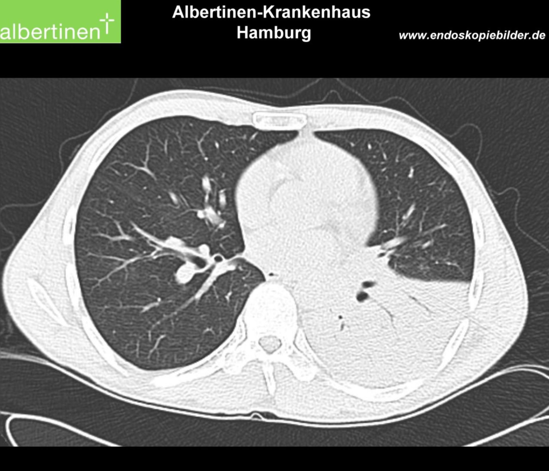 Lobärpneumonie sag CT