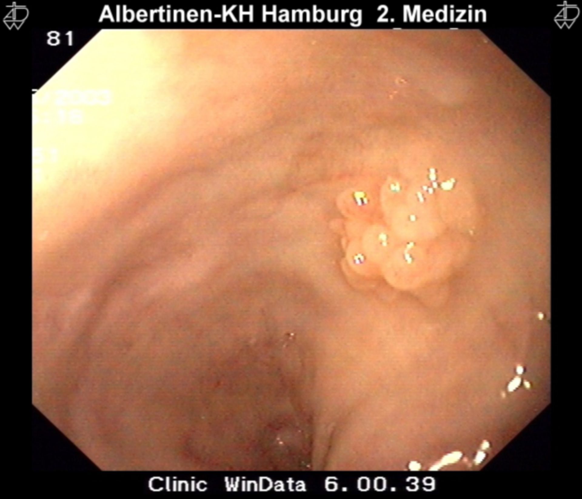 Polyp in the esophagus