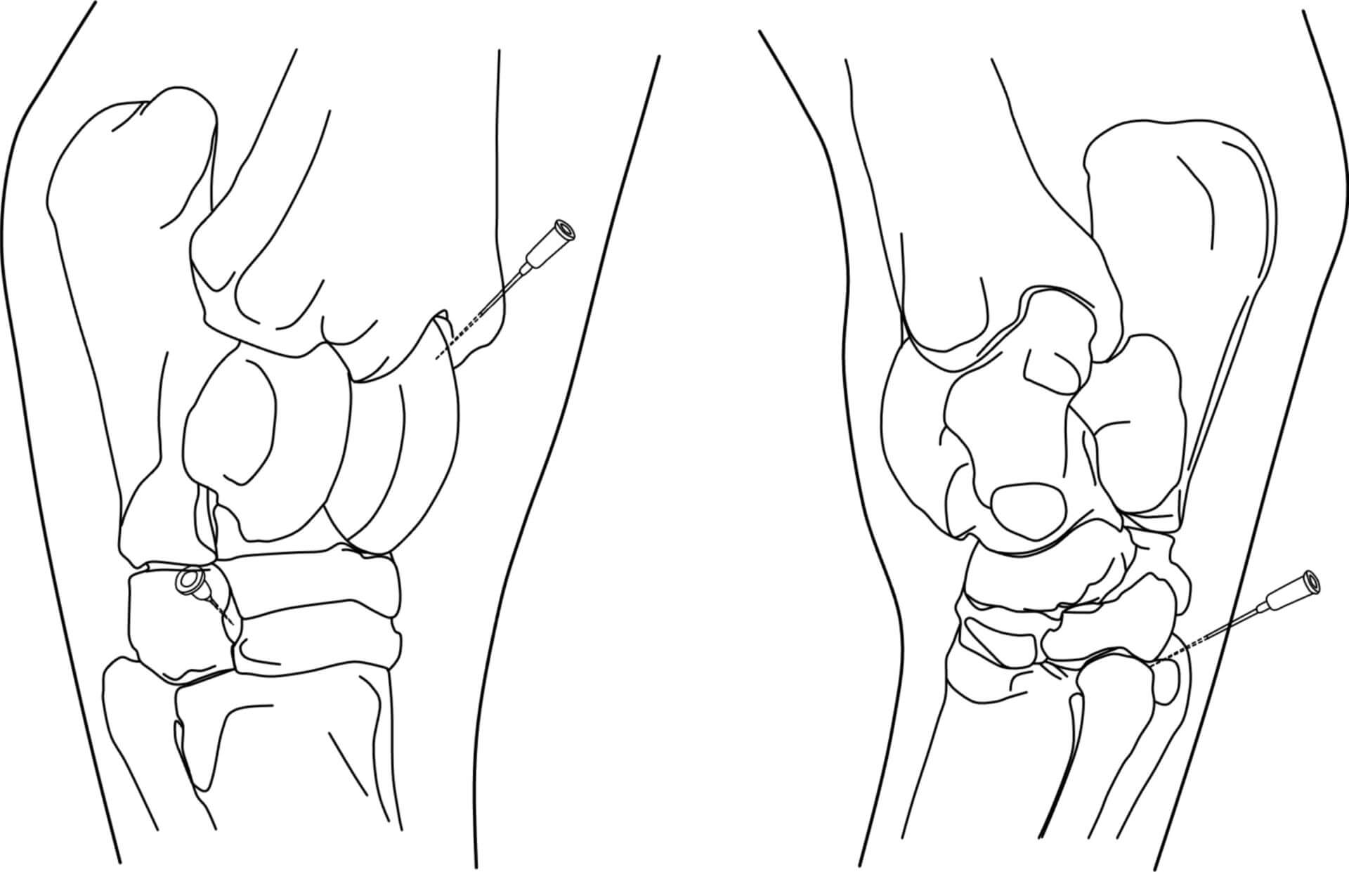 Tarsalgelenkpunktion (© Patrick Messner)