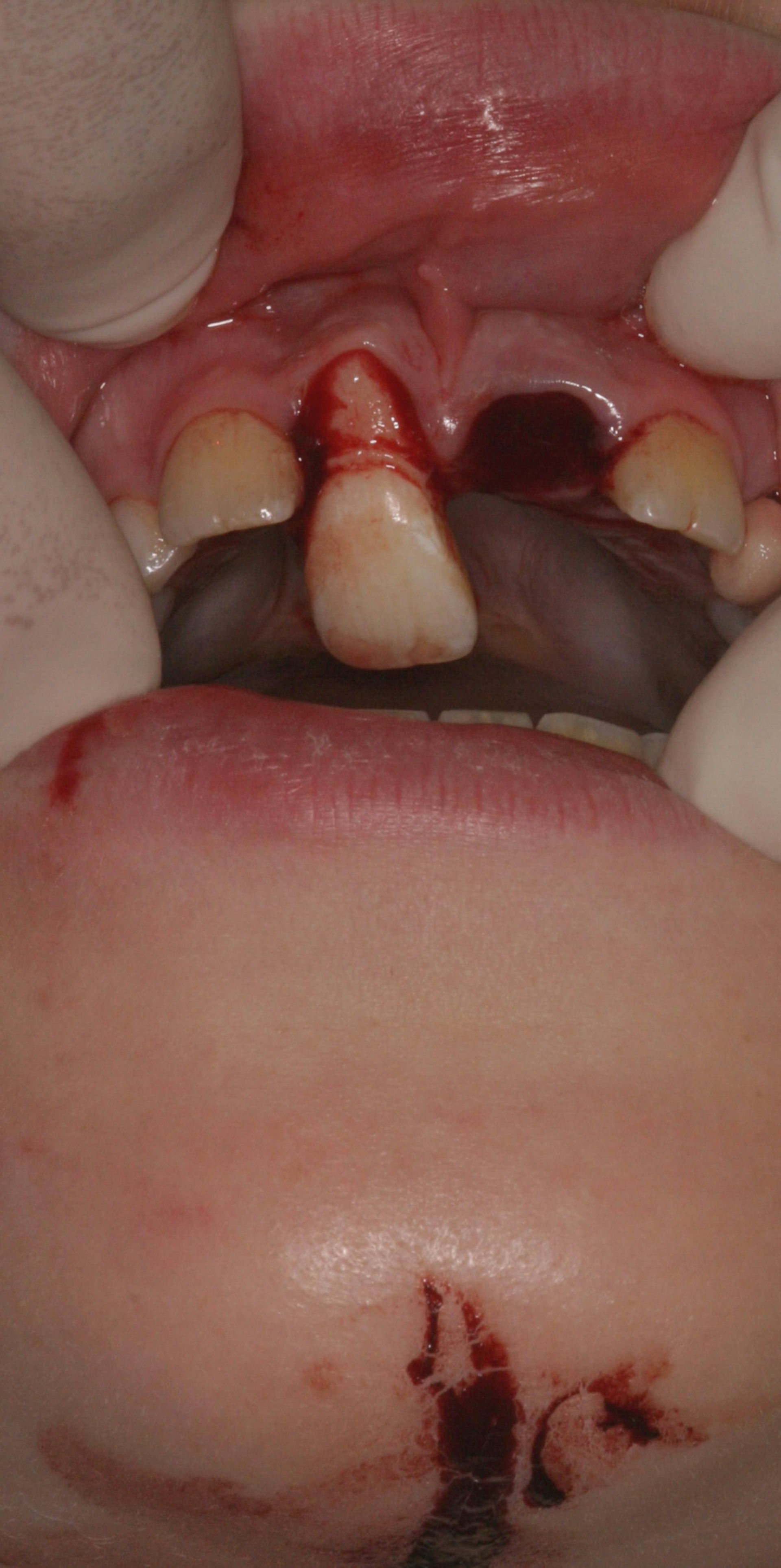 Front tooth trauma