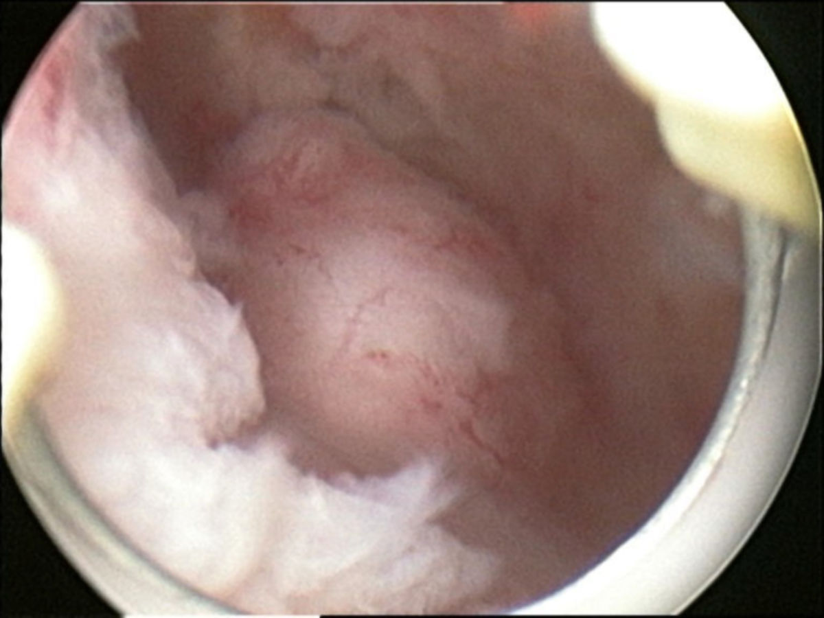 Submucöses Myom der Gebärmutterhinterwand (Hysteroskopie)