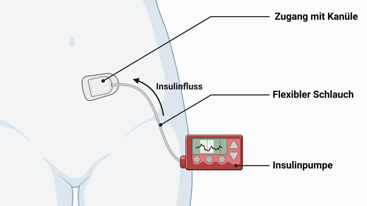 Insulinpumpe