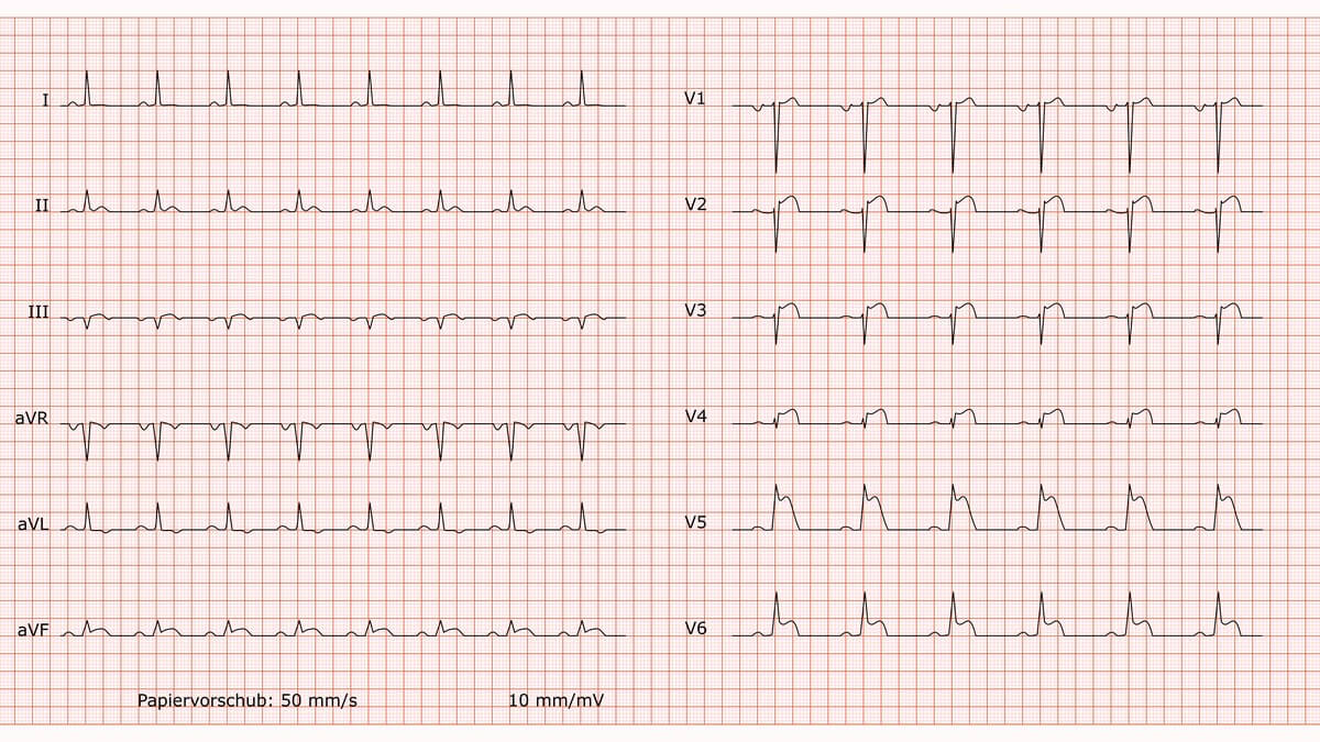 12-Kanal-EKG bei Vorderwandinfarkt