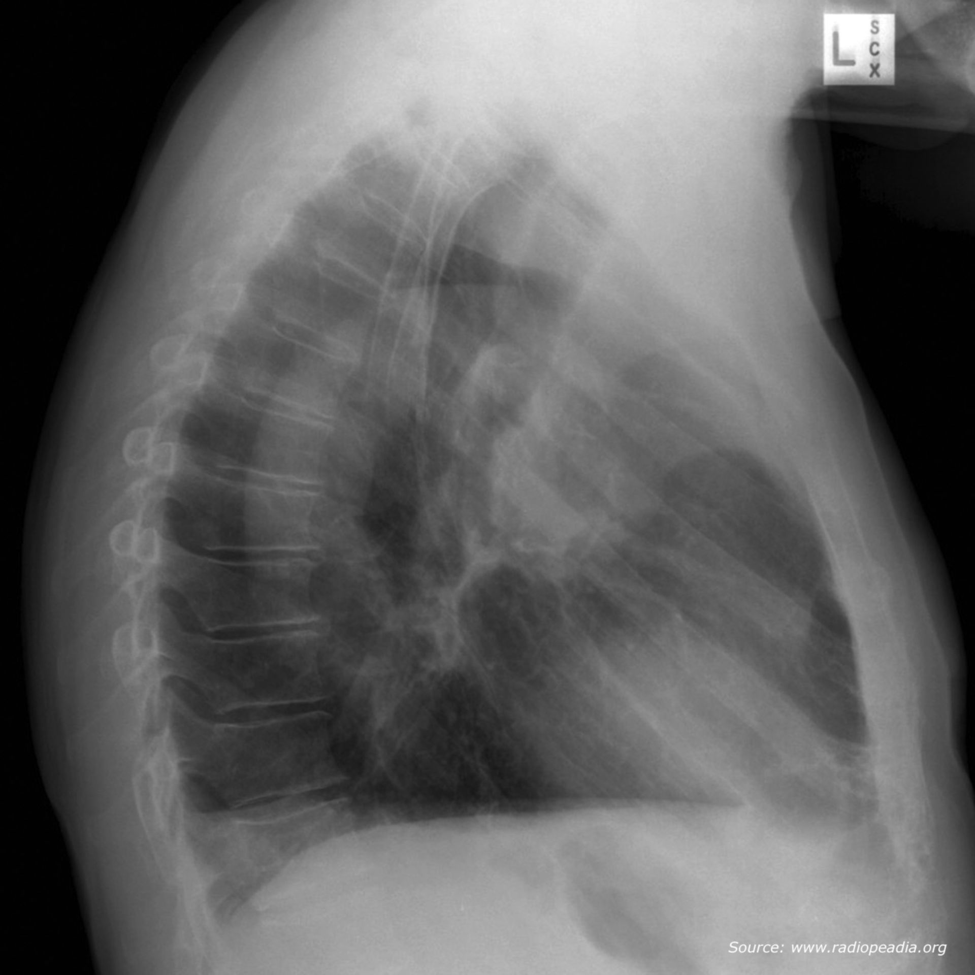 Röntgen-Thorax seitlich (Bildrätsel)