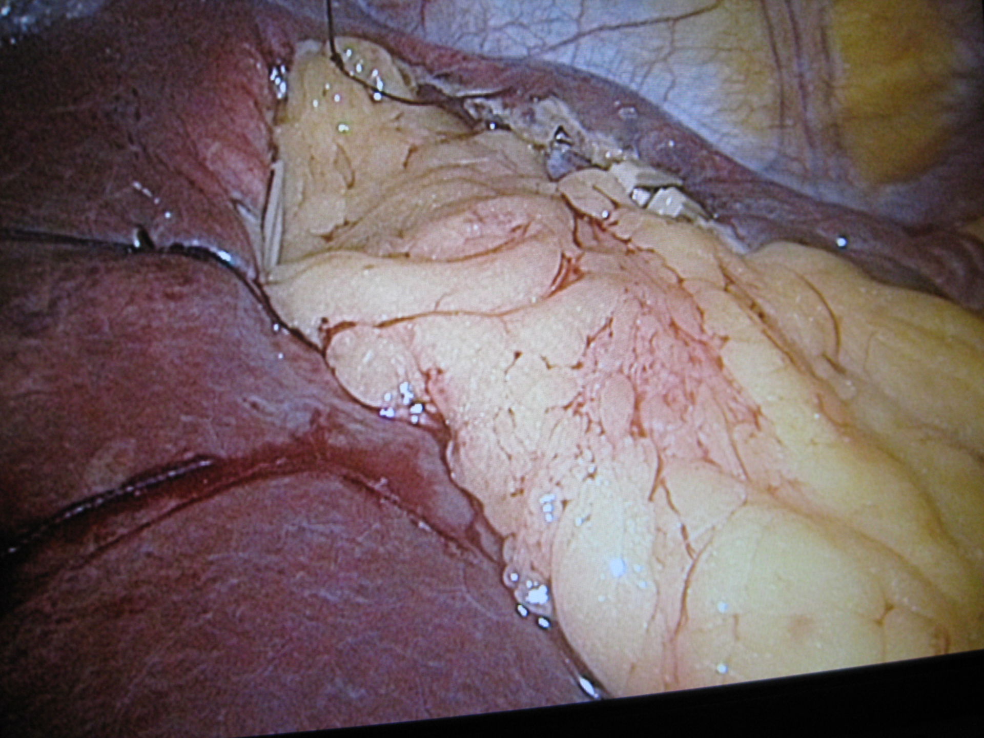 Leberzyste-Netzplombe laparoskopisch eingebracht