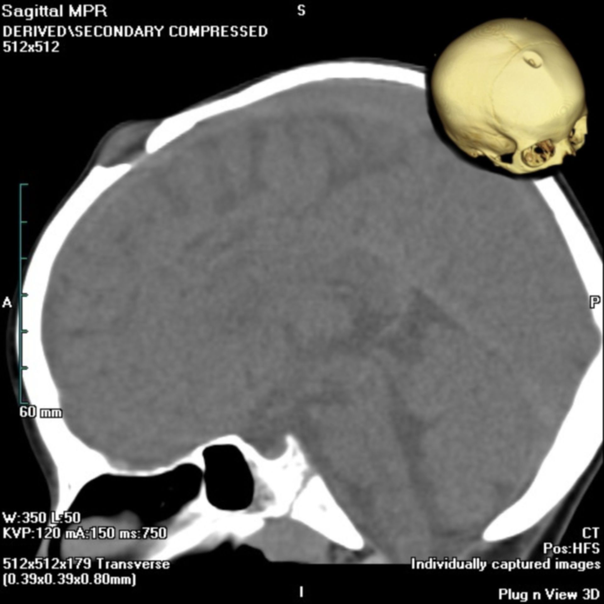 Dermoidzyste Schädel (CT mit 3D-Rekonstruktion)