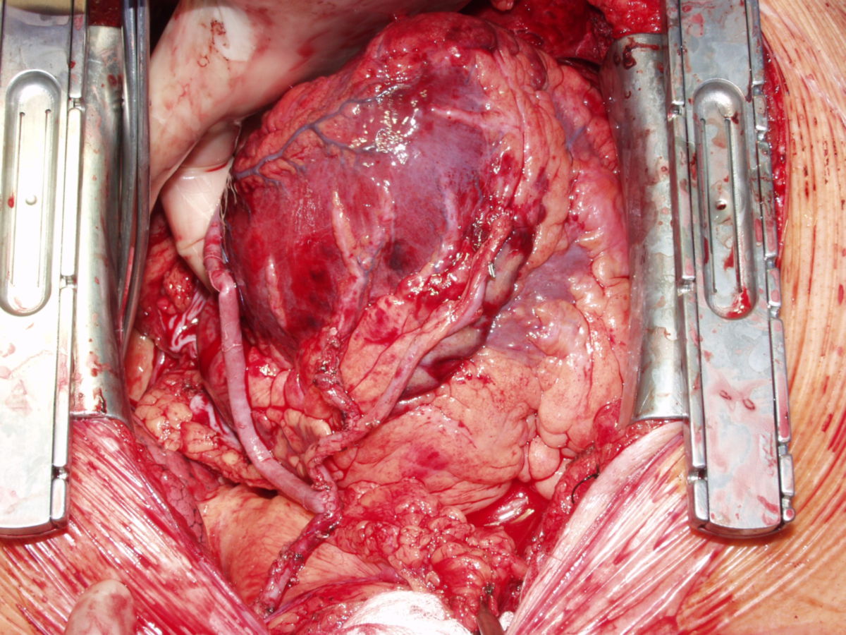 Bypass-OP mit totaler arterieller Revaskularisation (Abb. 2e)