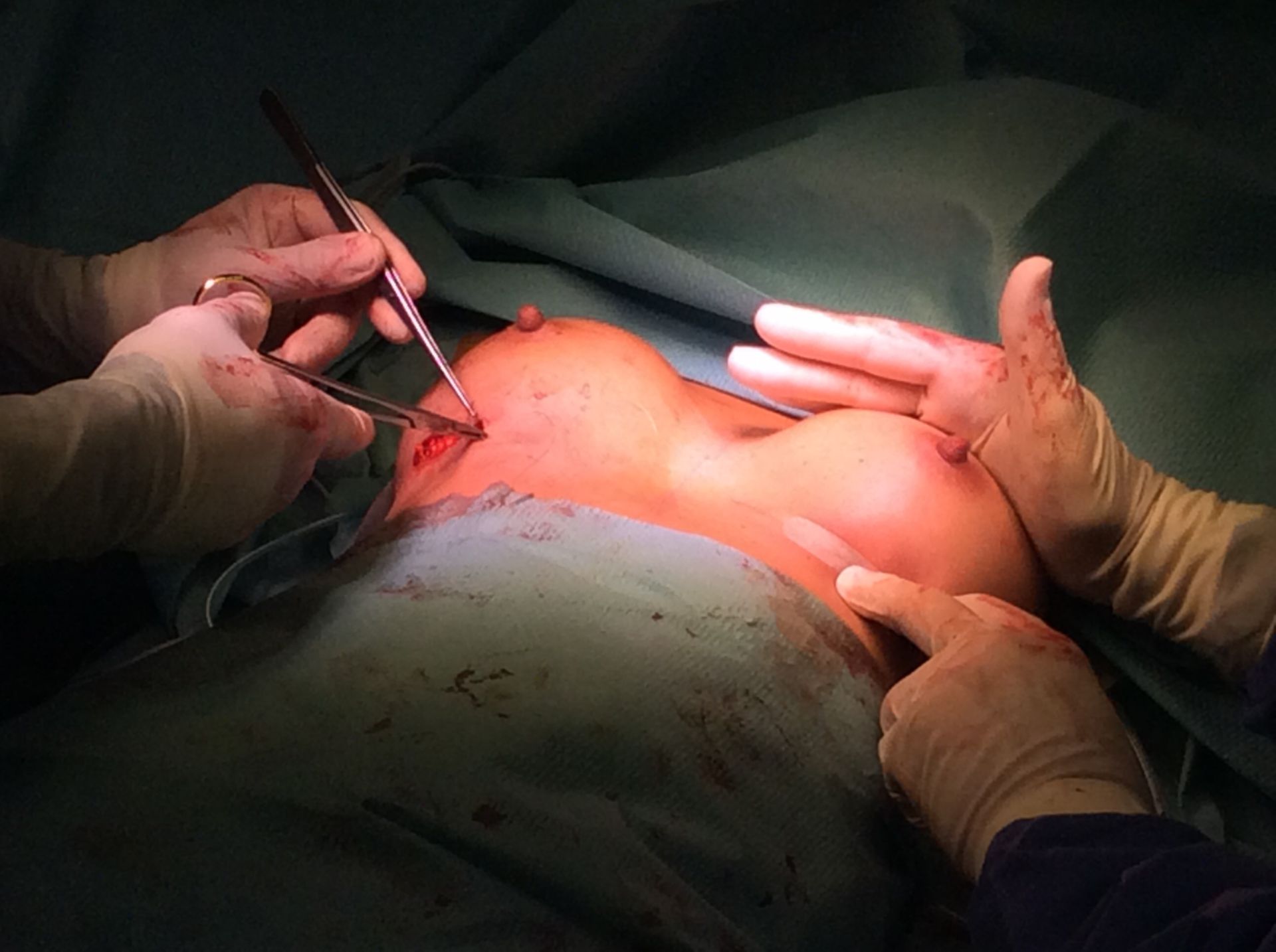 Surgical procedure of breast augmentation