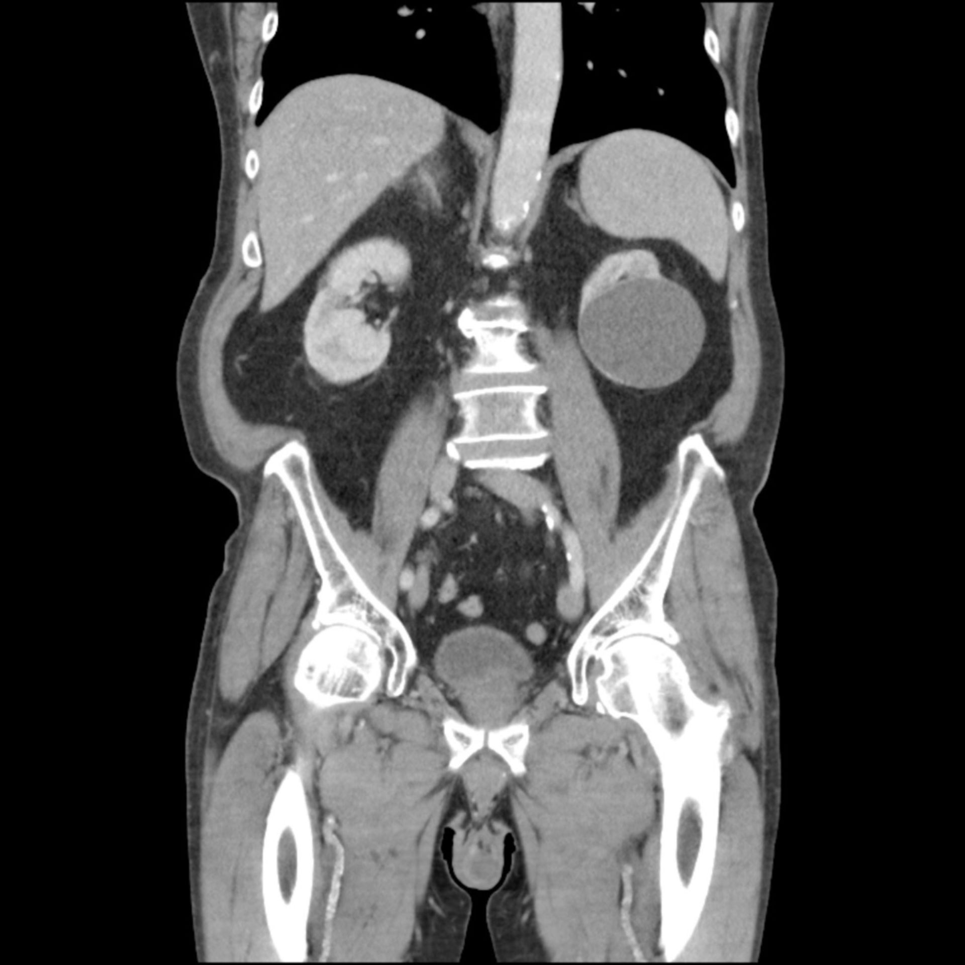 CT des Abdomens in frontaler Ebene mit großer Zyste links