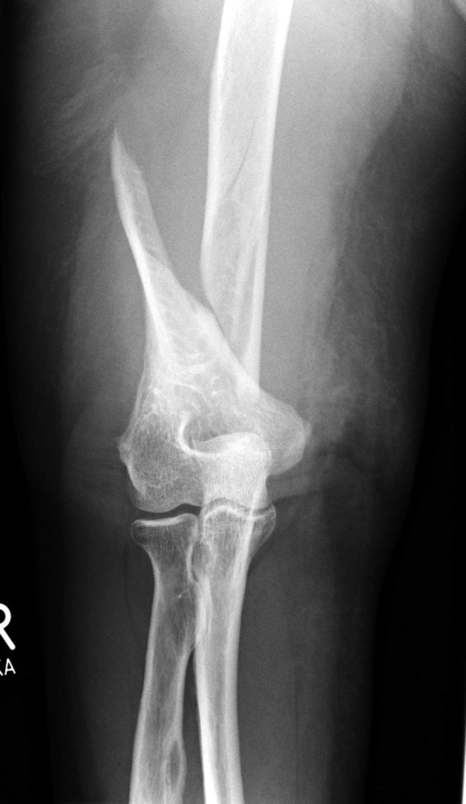 Supracondylar fracture of humerus