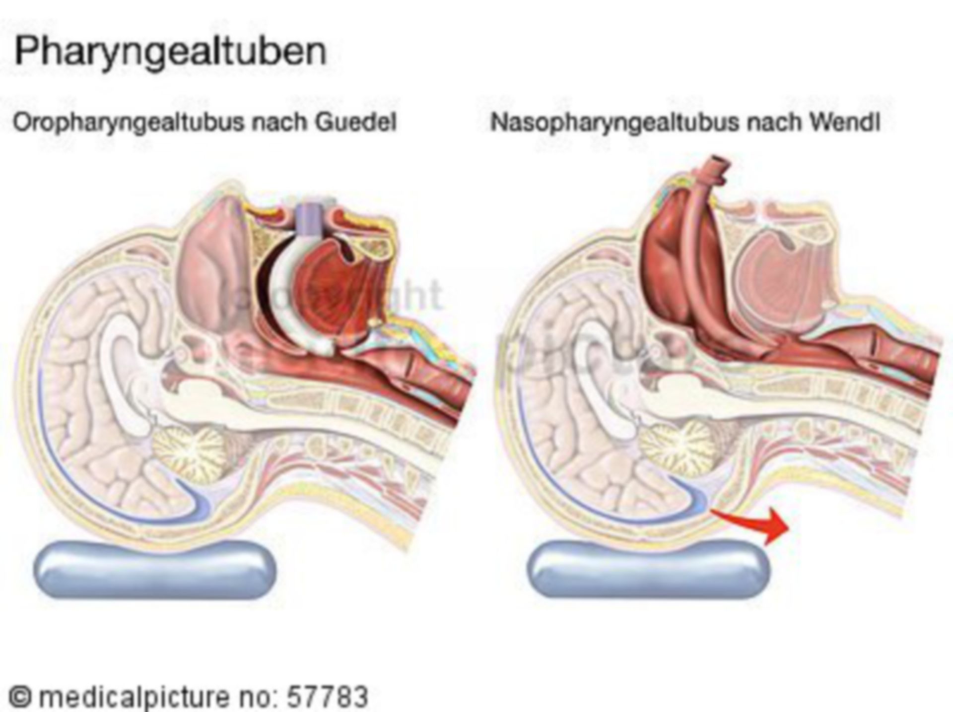 Comparison of Guedel and Wendle tube