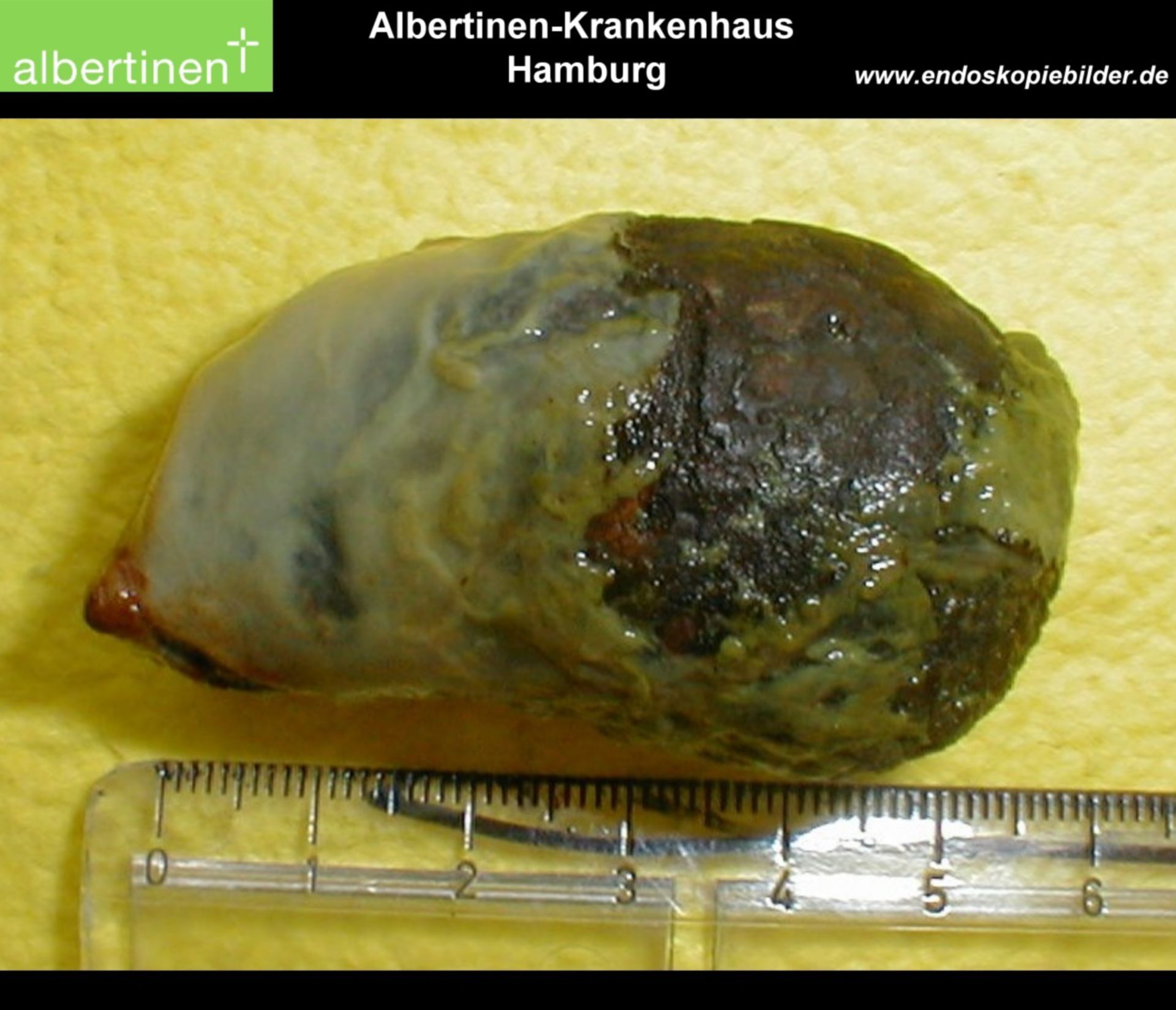 Gall bladder calculus