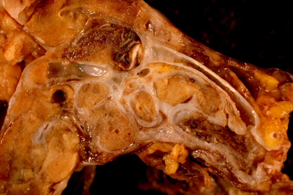 Uterus-Tumor einer 33-Jährigen Patientin (2)