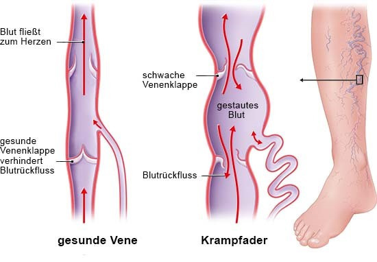 vergleich_venenklappen_entwurf_2_17-9-19