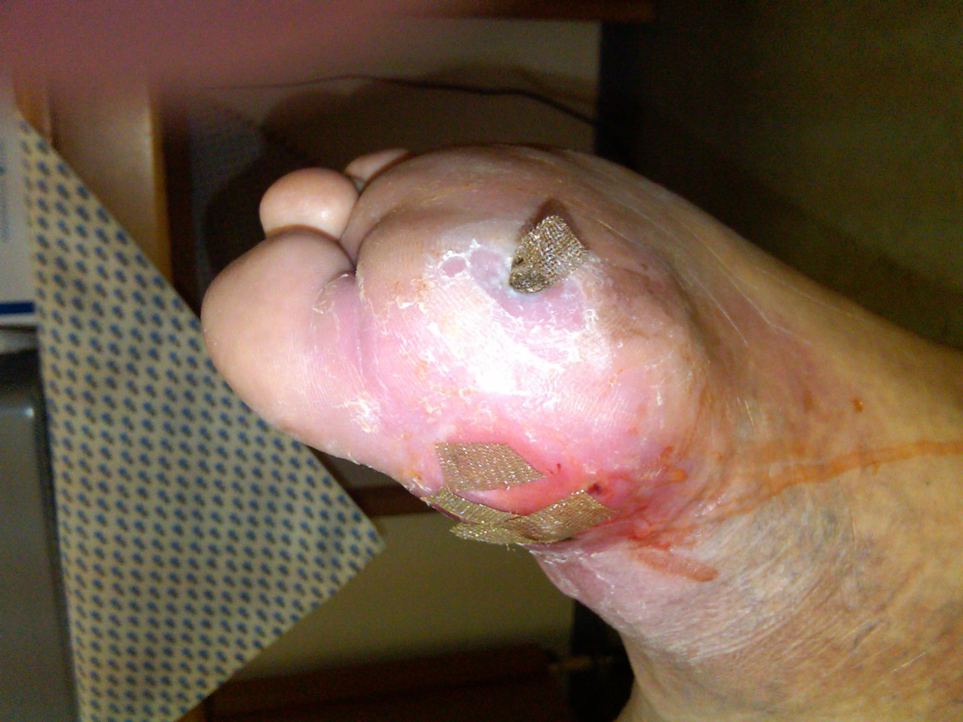 diabetic foot