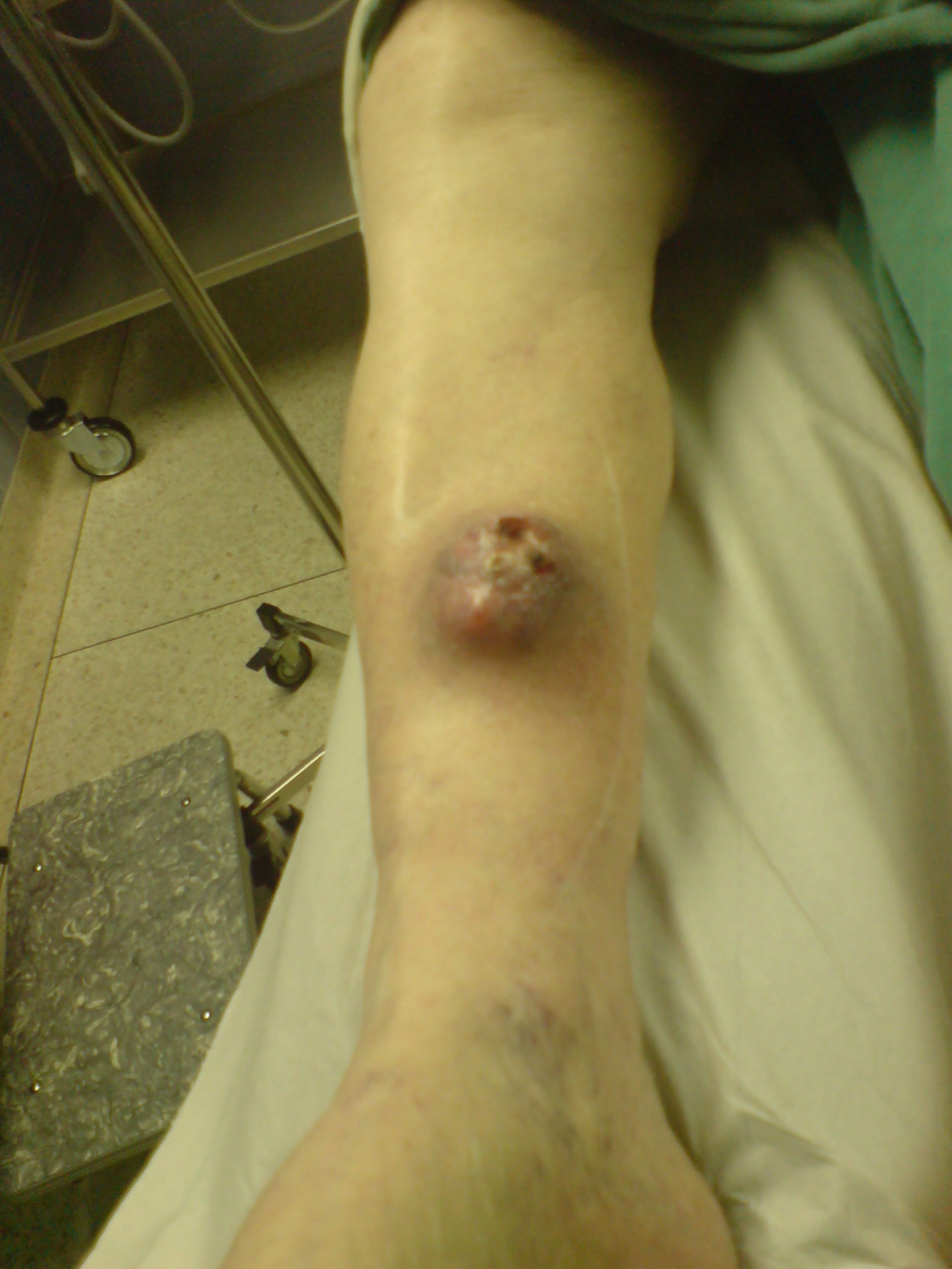 Malign histiocytoma on lower leg