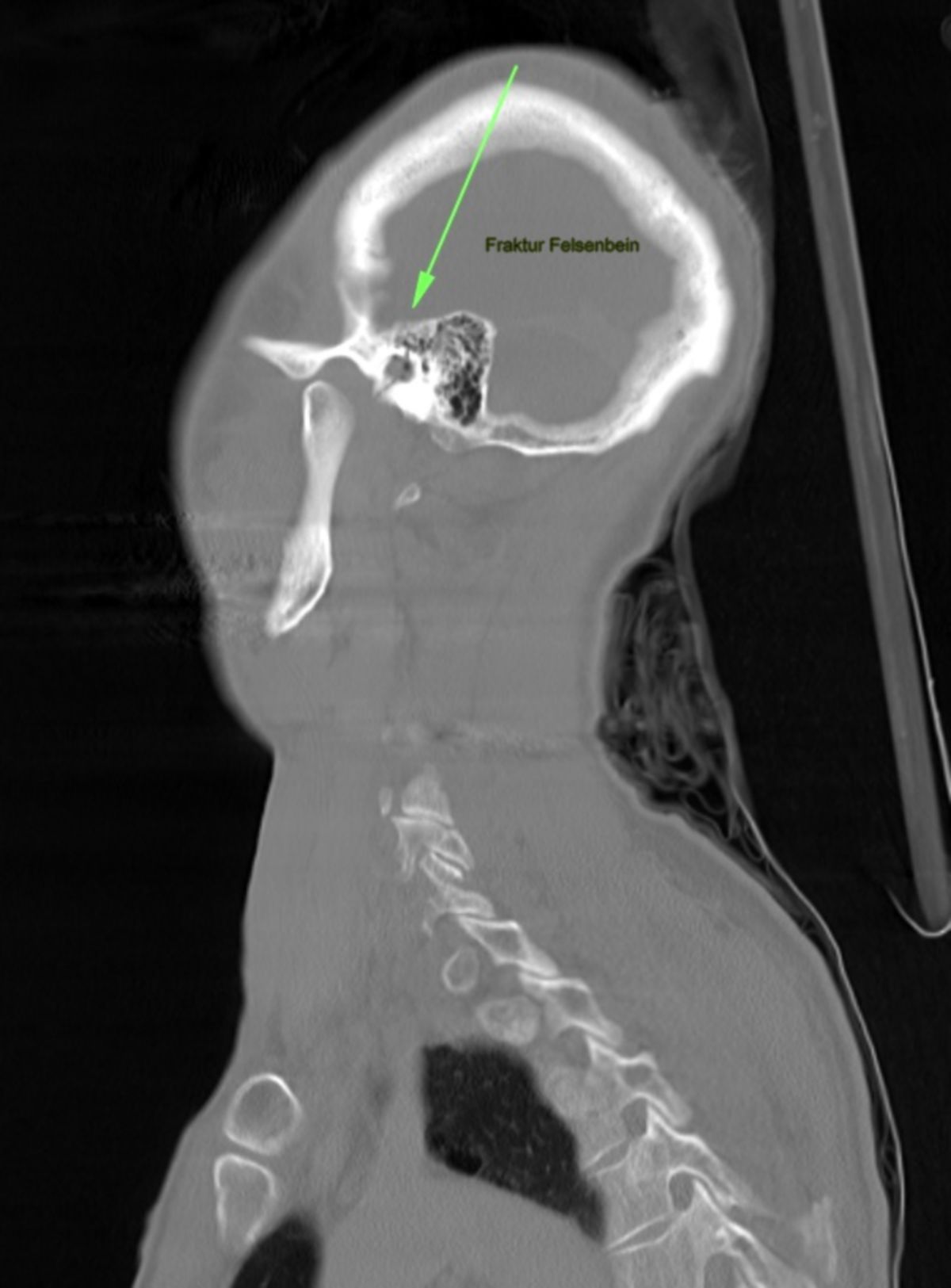 Felsenbeinfraktur- Spiral CT