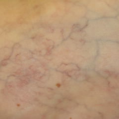 Hereditäre hämorrhagische Teleangiektasie DocCheck Flexikon