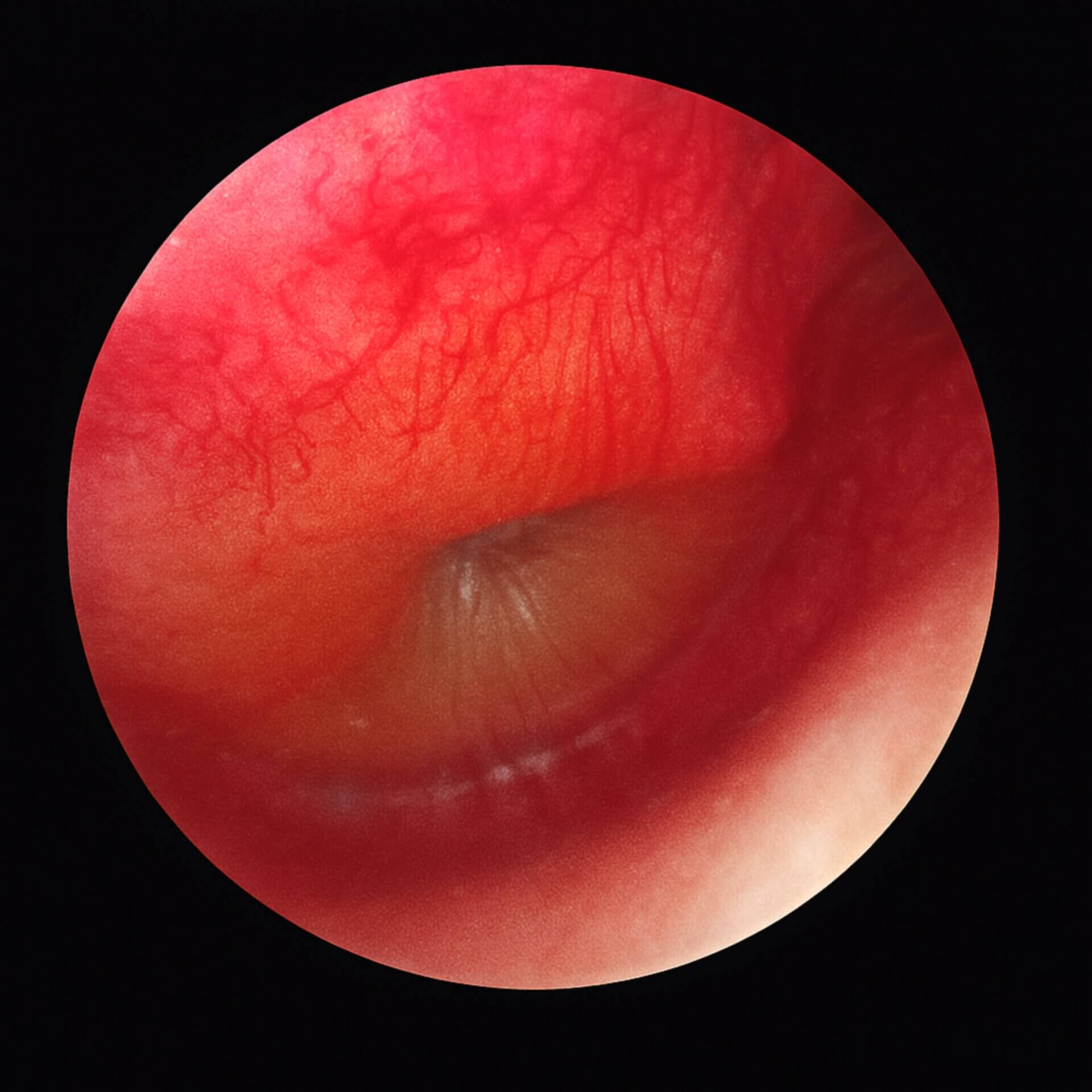 Otitis media acuta