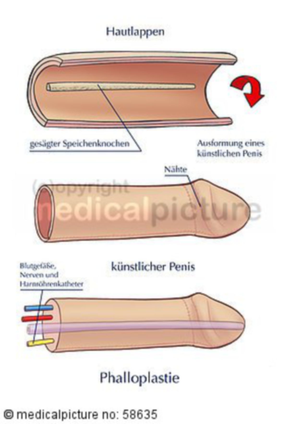 Penis trombose Åreforkalkning (Arteriosklerose