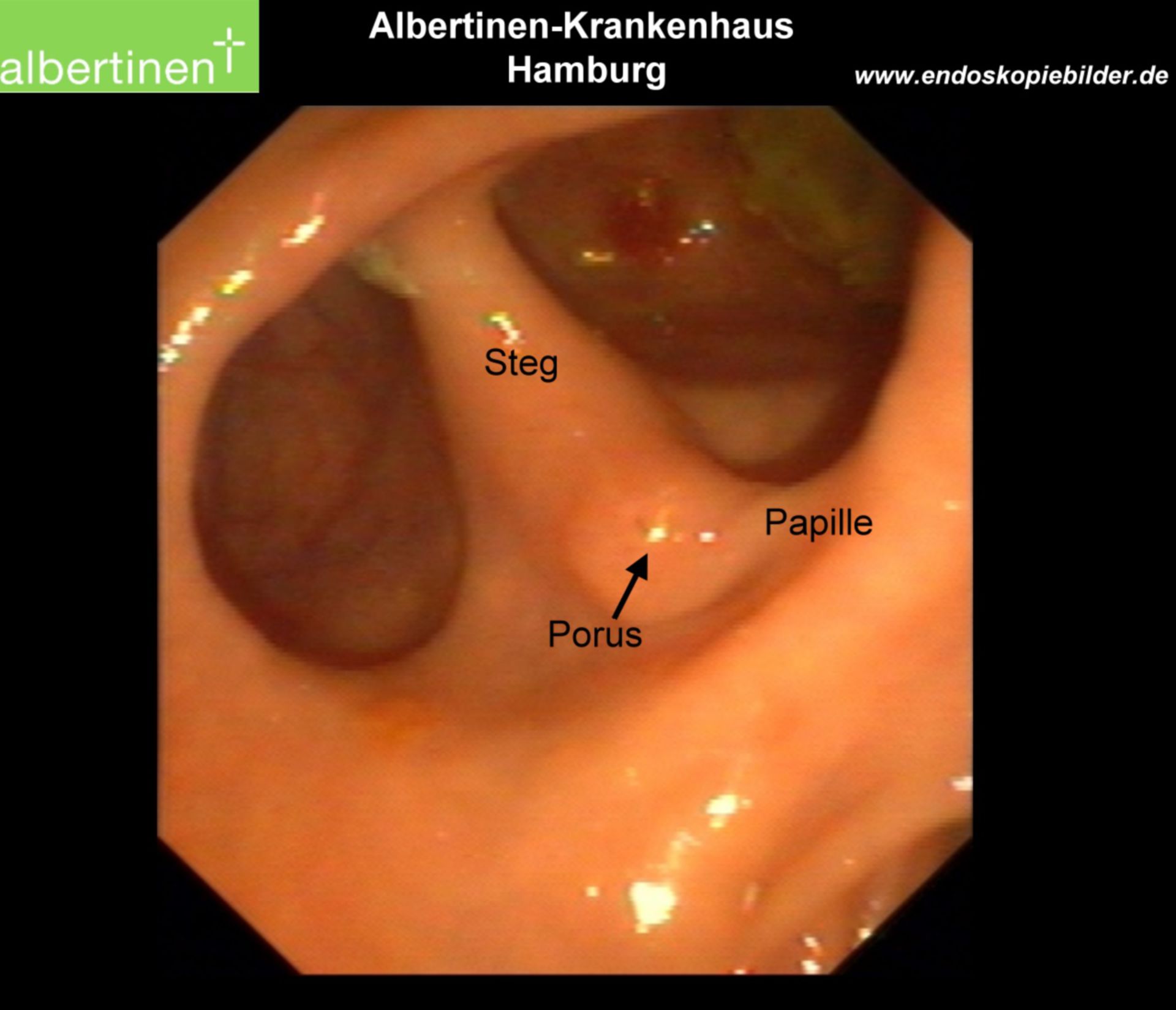 Endoscopy: Duodenal diverticulum on the papilla