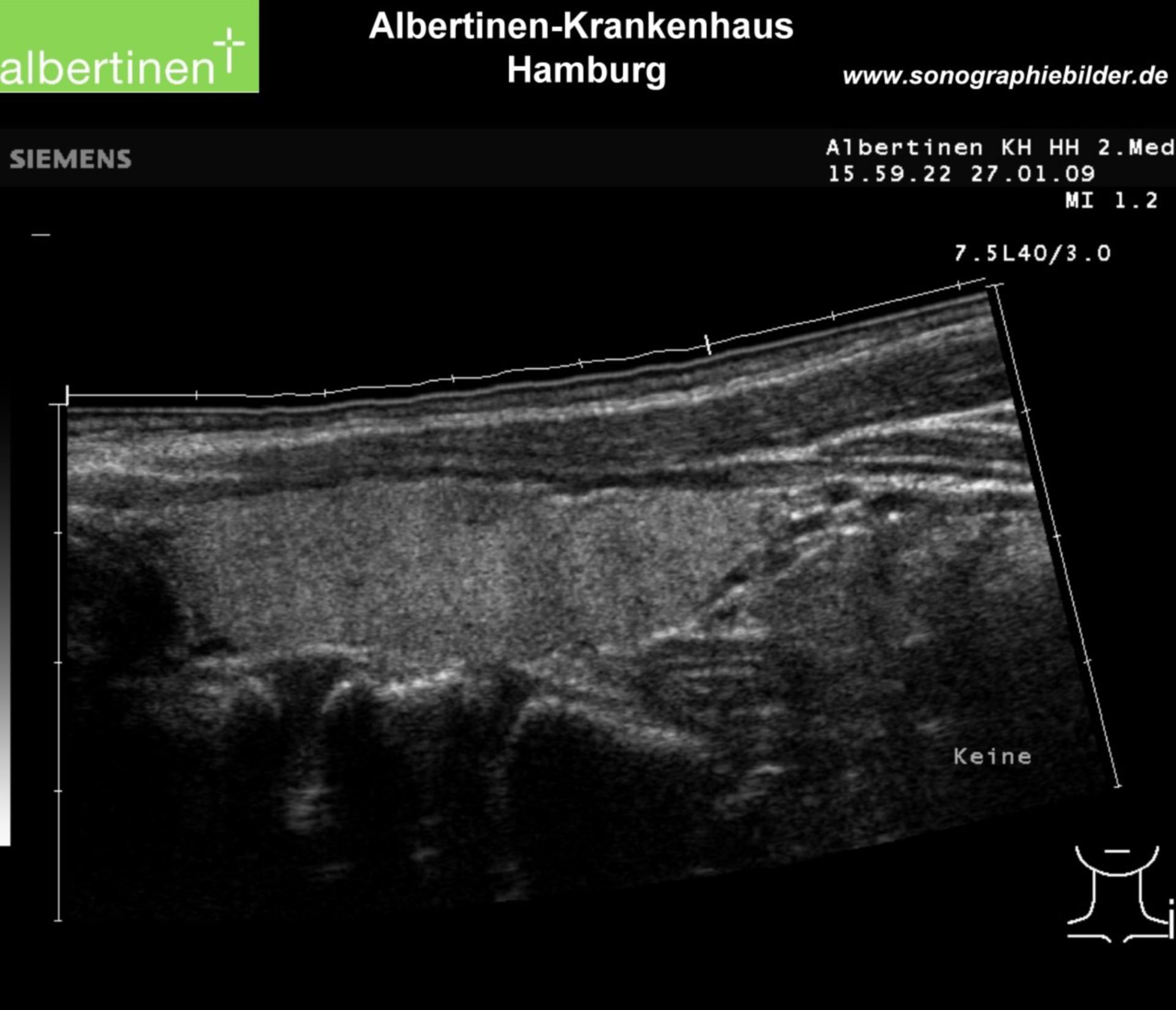Thiroid gland laterally - normal