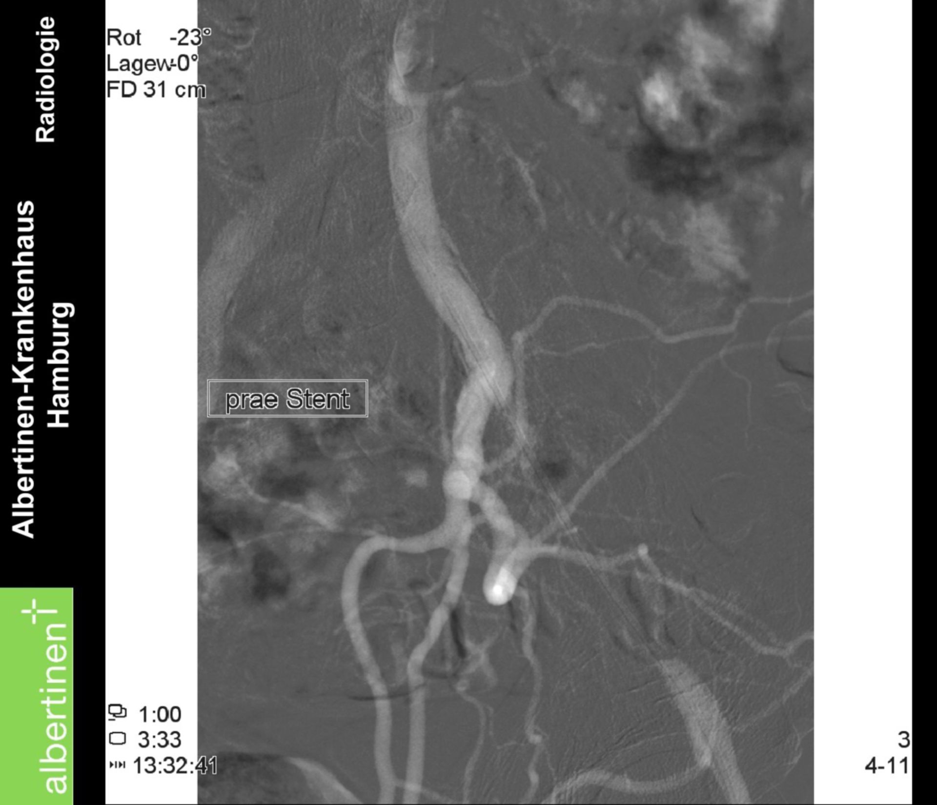 Angiografia digitale a sottrazione - occlusione prima di stent