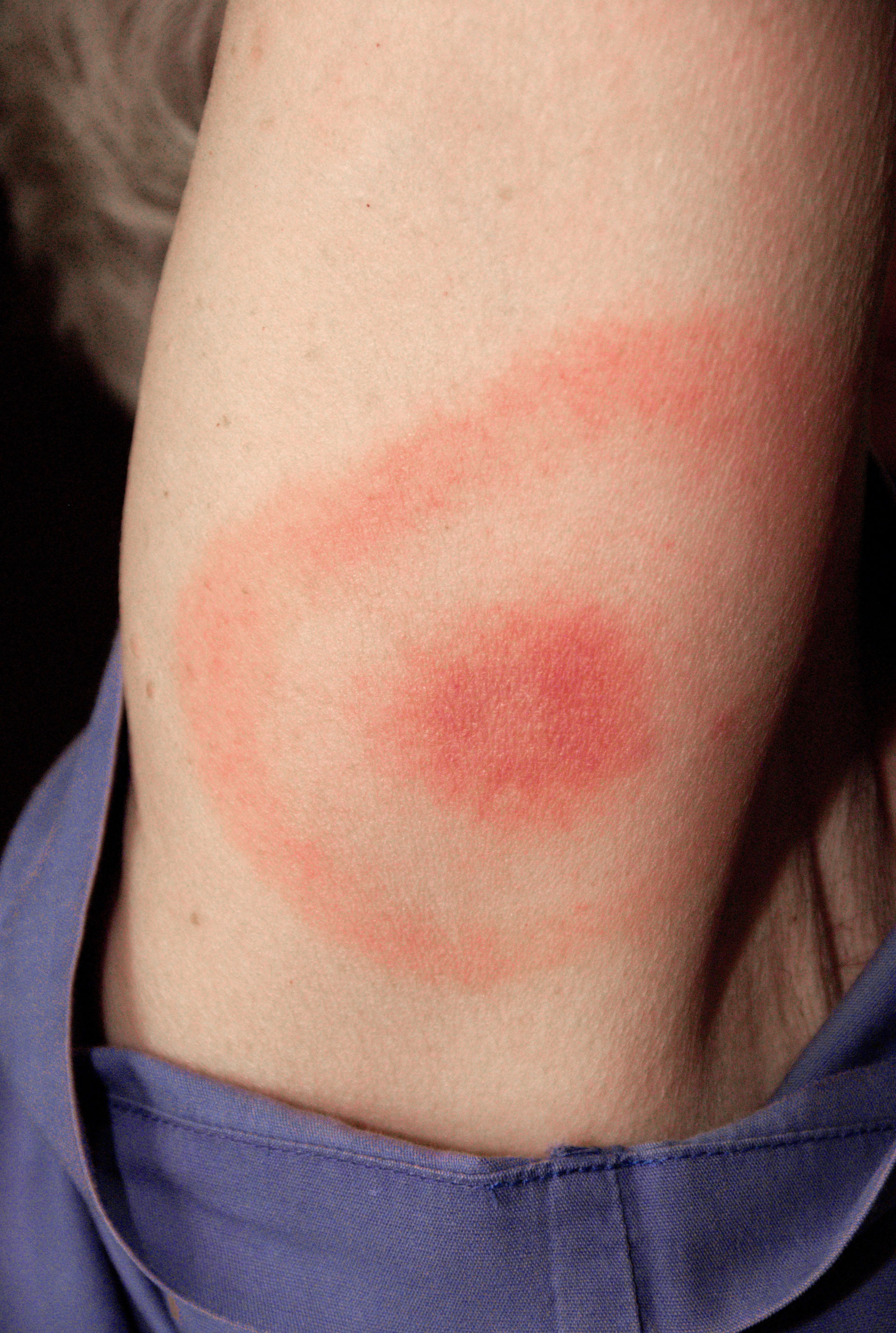Erythema migrans - erythematous rash in Lyme disease