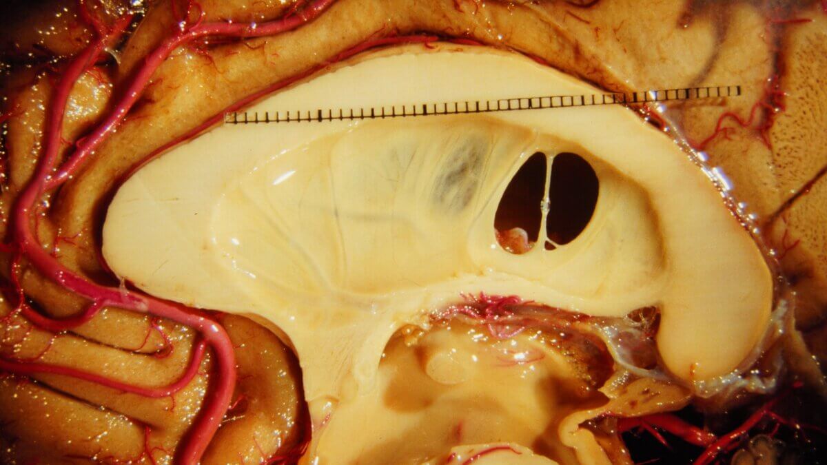 Corpus callosum