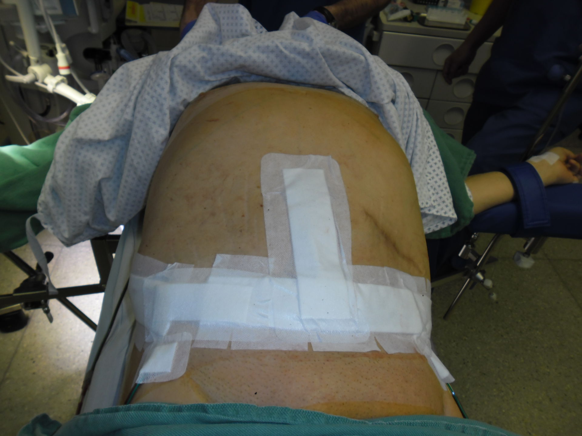 Fat apron - abdominoplasty - after surgery 1