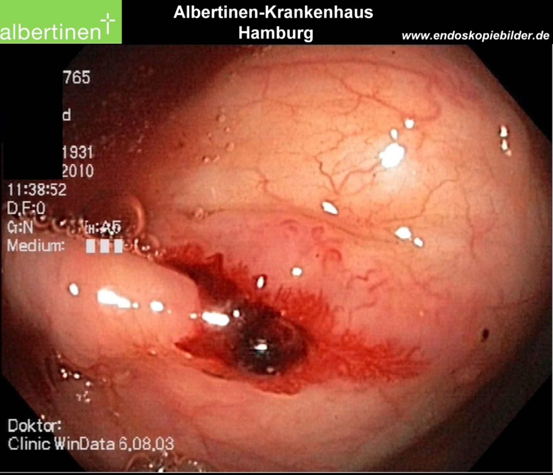 Endoscopy:Angiodysplasia in the colon