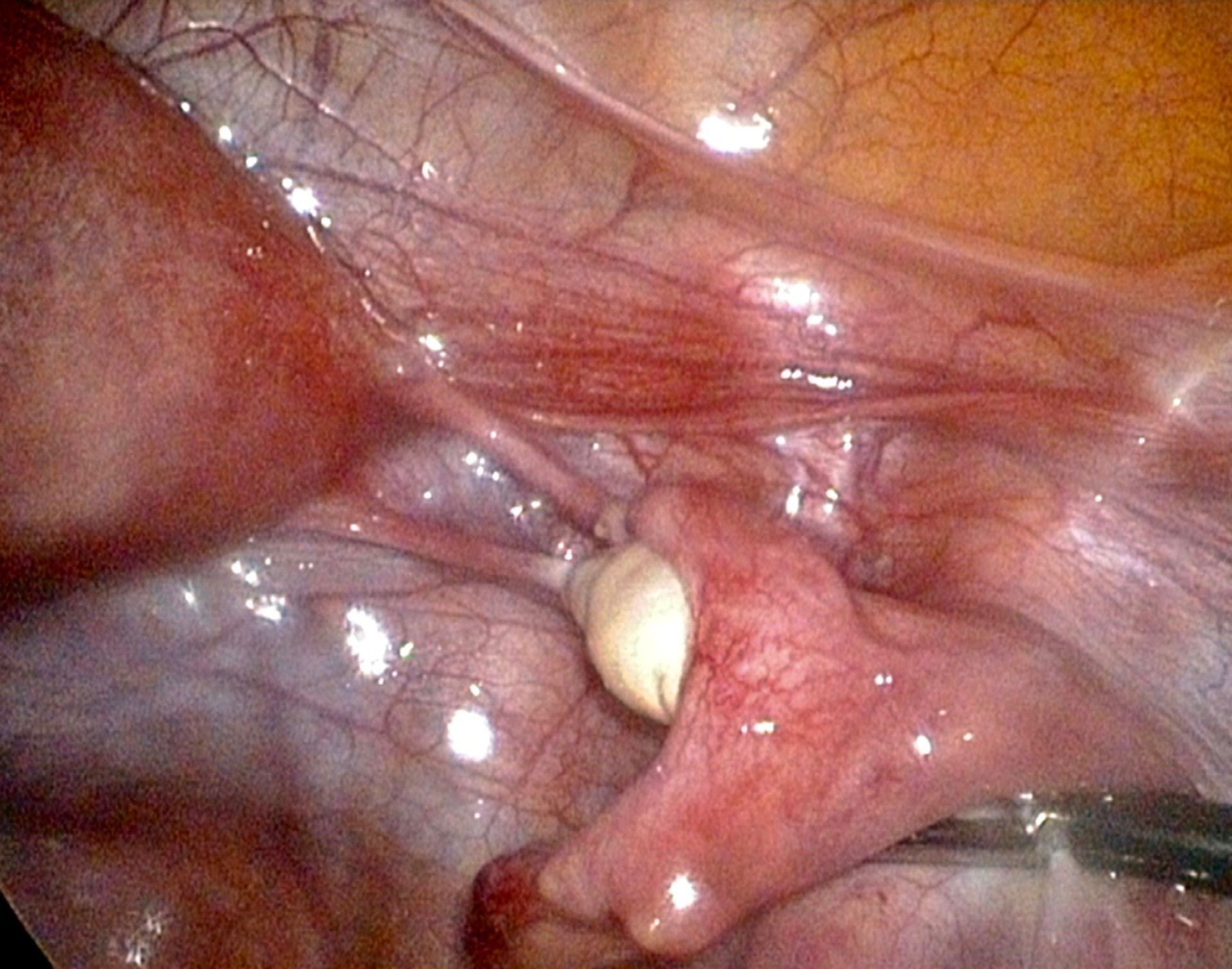 Uterus mit rechter Adnexe