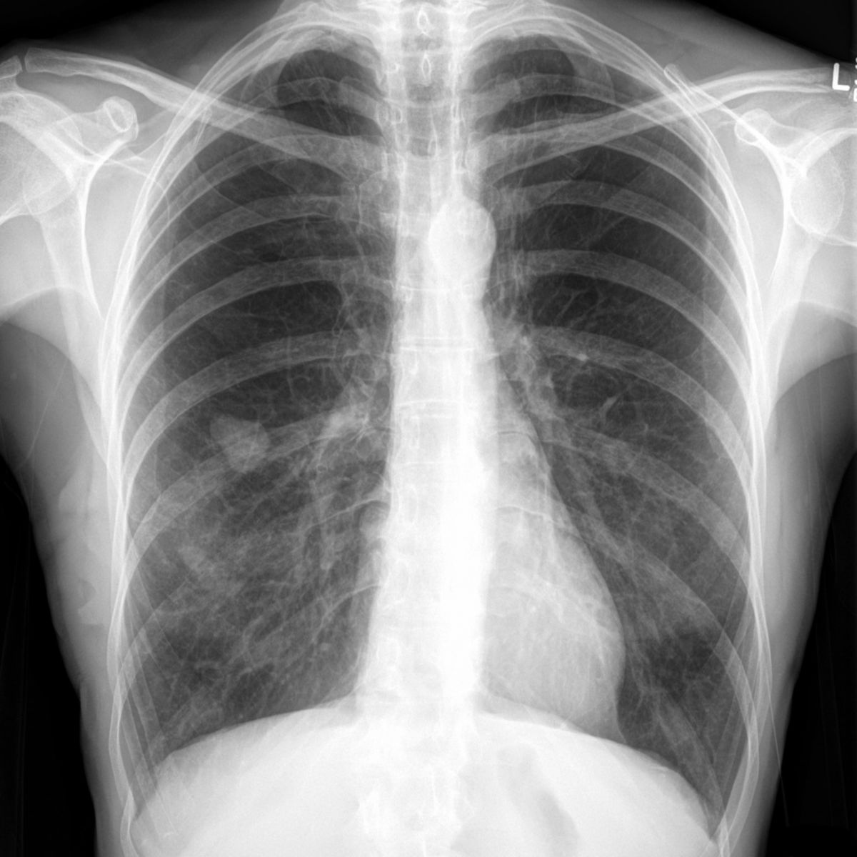 Röntgen-Thorax, a.p.: COPD, Melanom Metastase