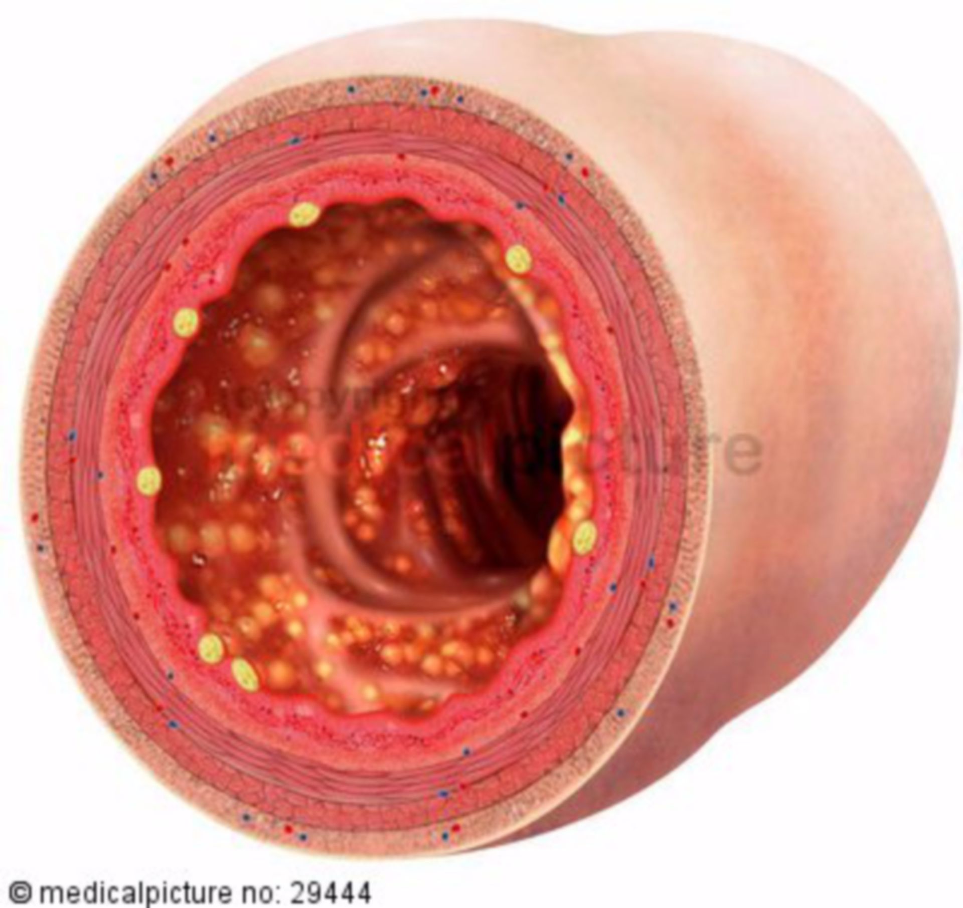 Lumen eines Dickdarms mit Colitis ulcerosa