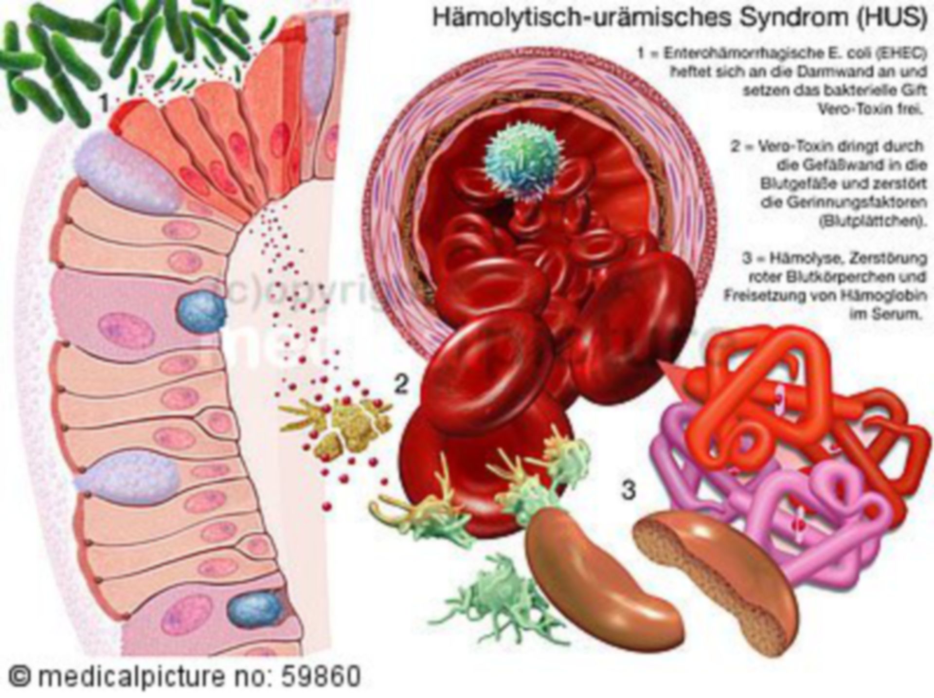 EHEC-HUS