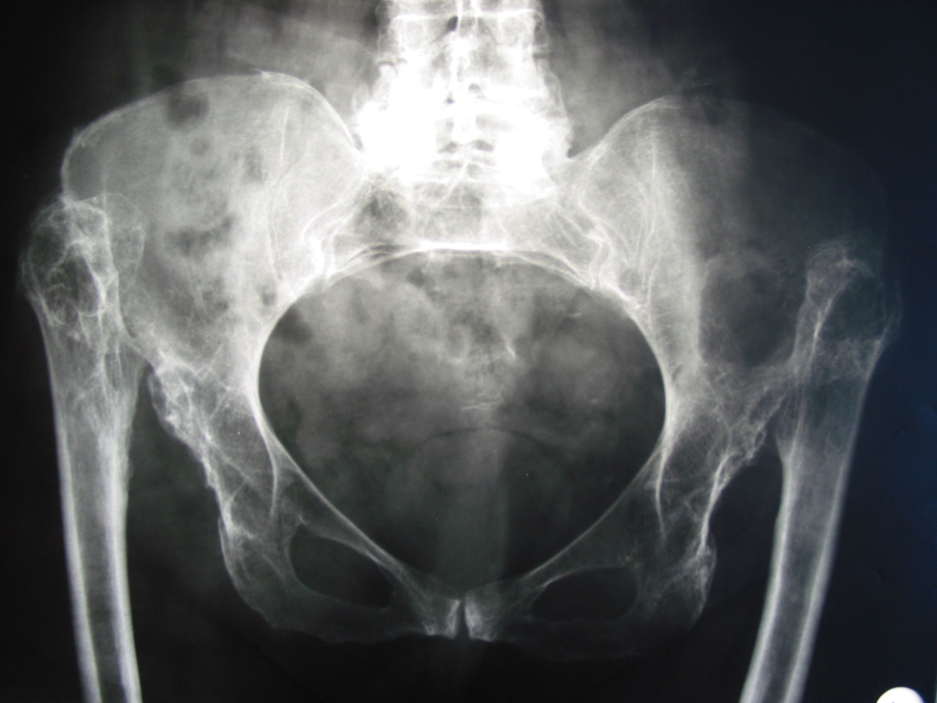 Severe developmental dysplasia of the hip