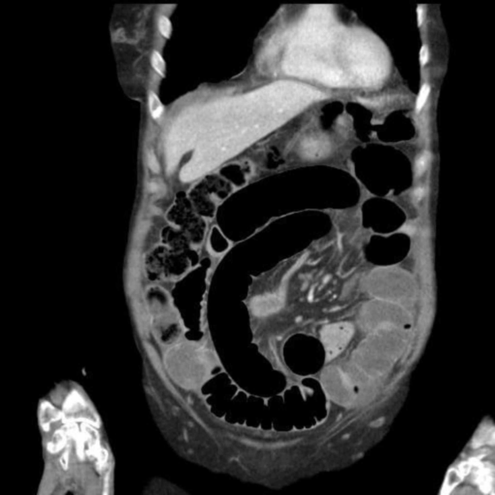 Dünndarmstenose CT